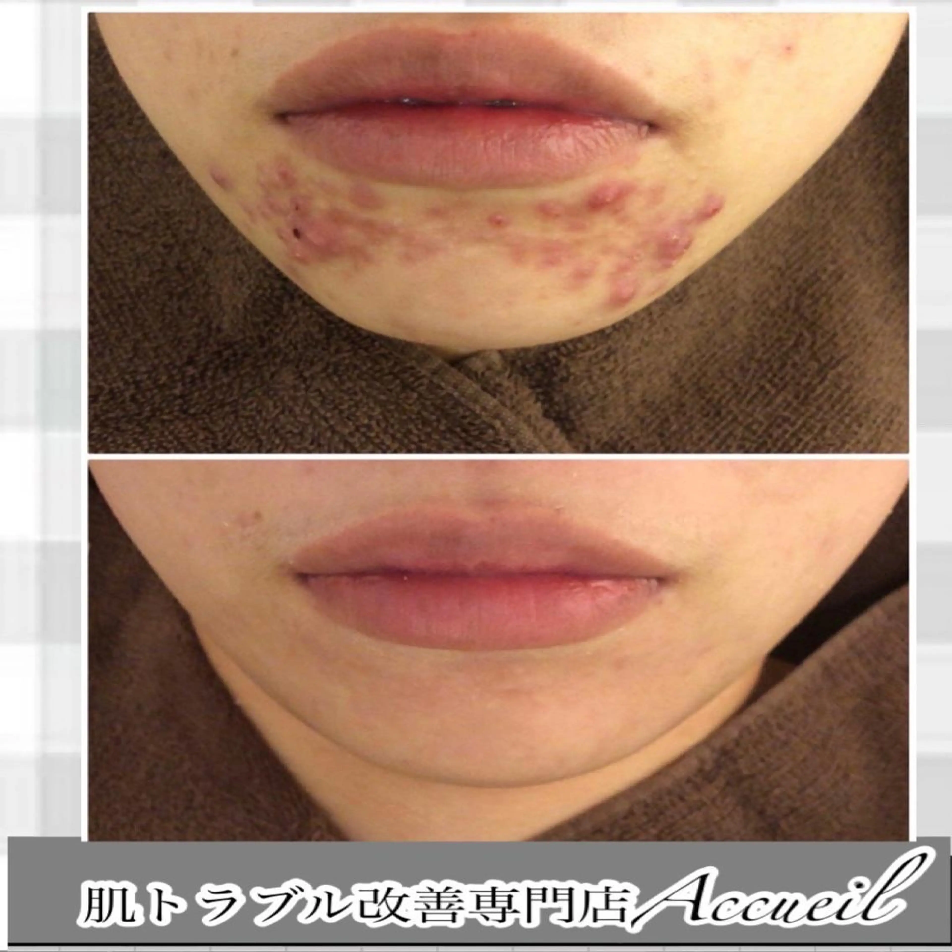 セミロング カラー パーマ ヘアアレンジ メンズ キッズ ネイル マツエク・マツパ アイブロウ エステ リラク ニキビ特化型エステ 🍓最短で肌質改善のエステ・リラクイメージ