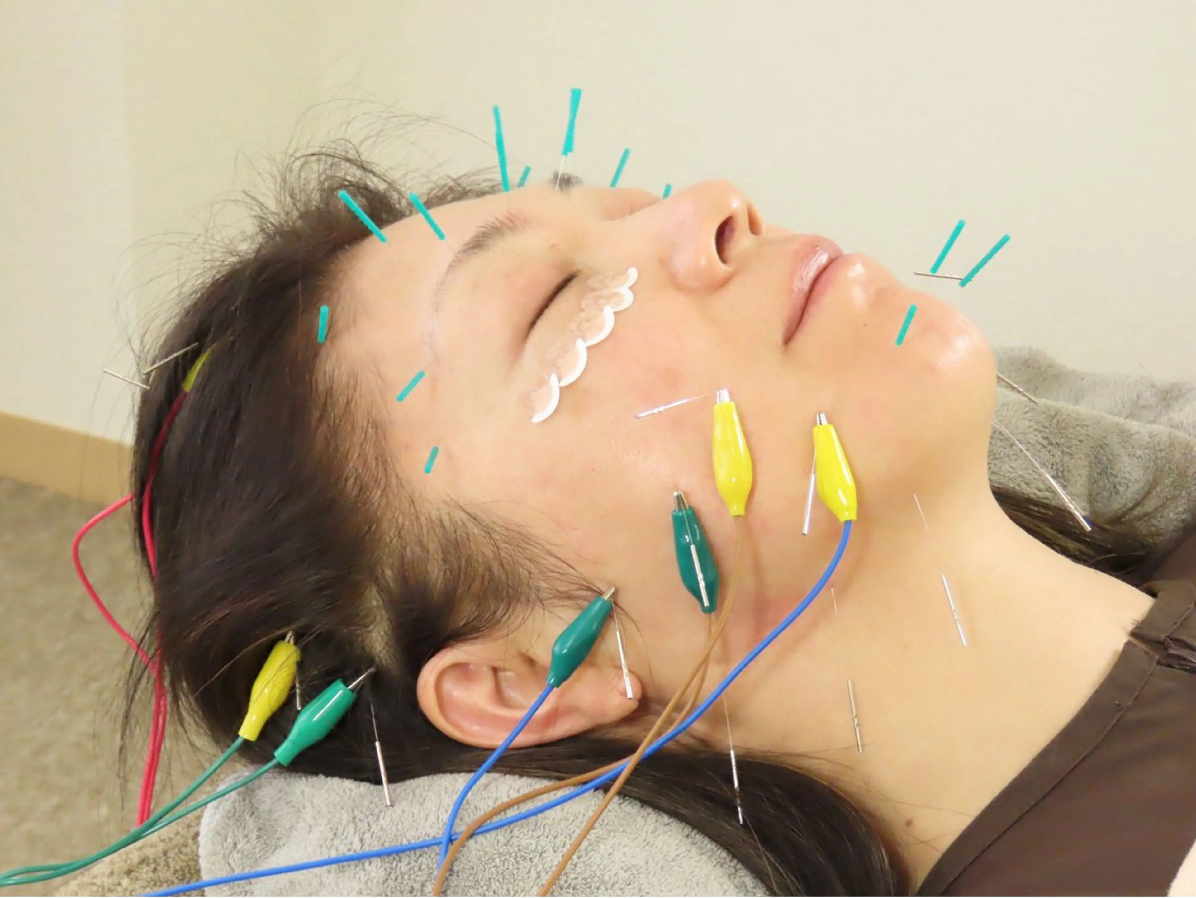 （初回）【美容鍼+全身調整鍼+幹細胞化粧水】美容鍼鍼通電コースの写真