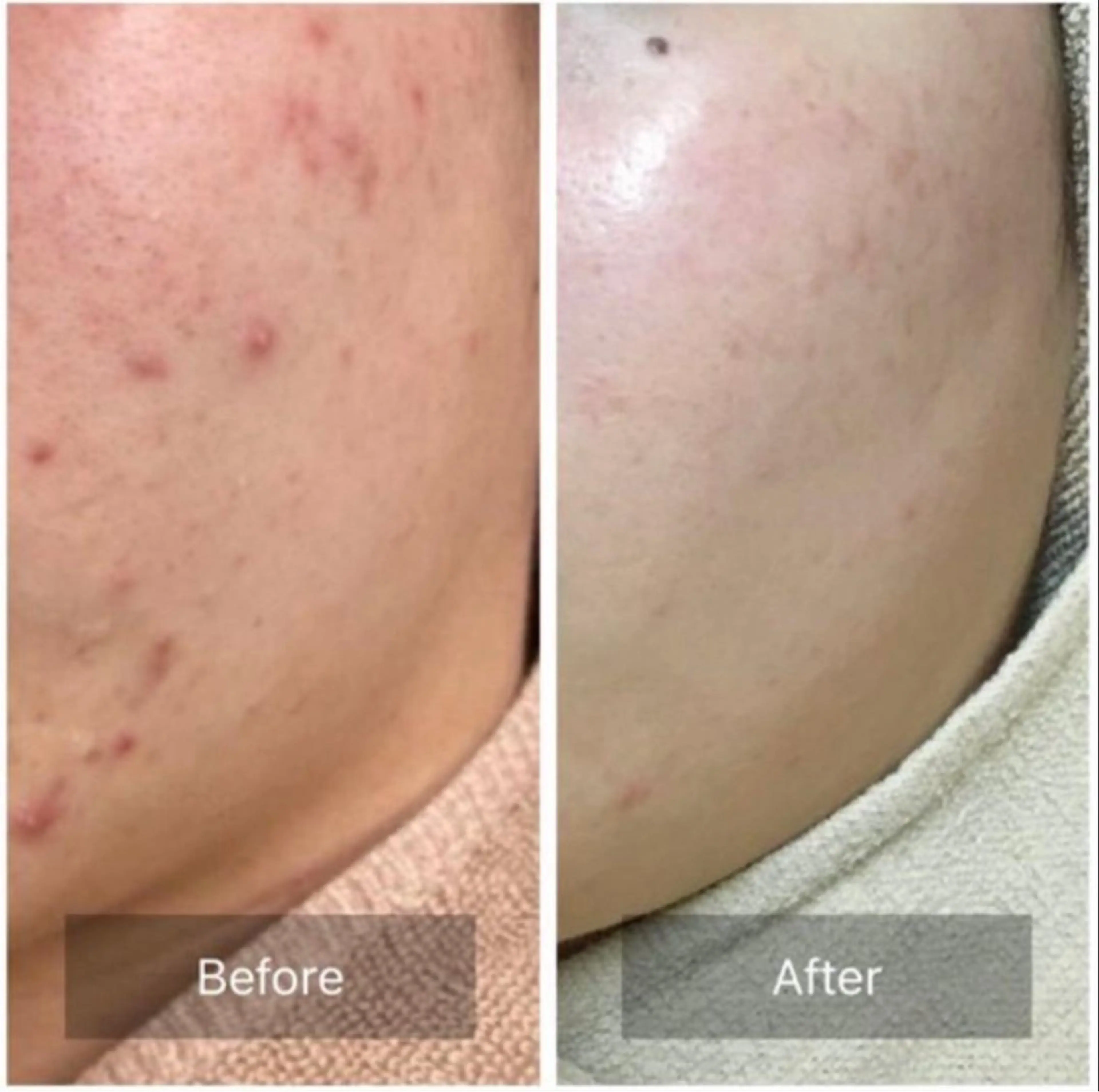 エステ Auguspa〜オーガスパ〜所属・つるんとむき卵肌に 🌟ハーブピーリングのエステ・リラクイメージ