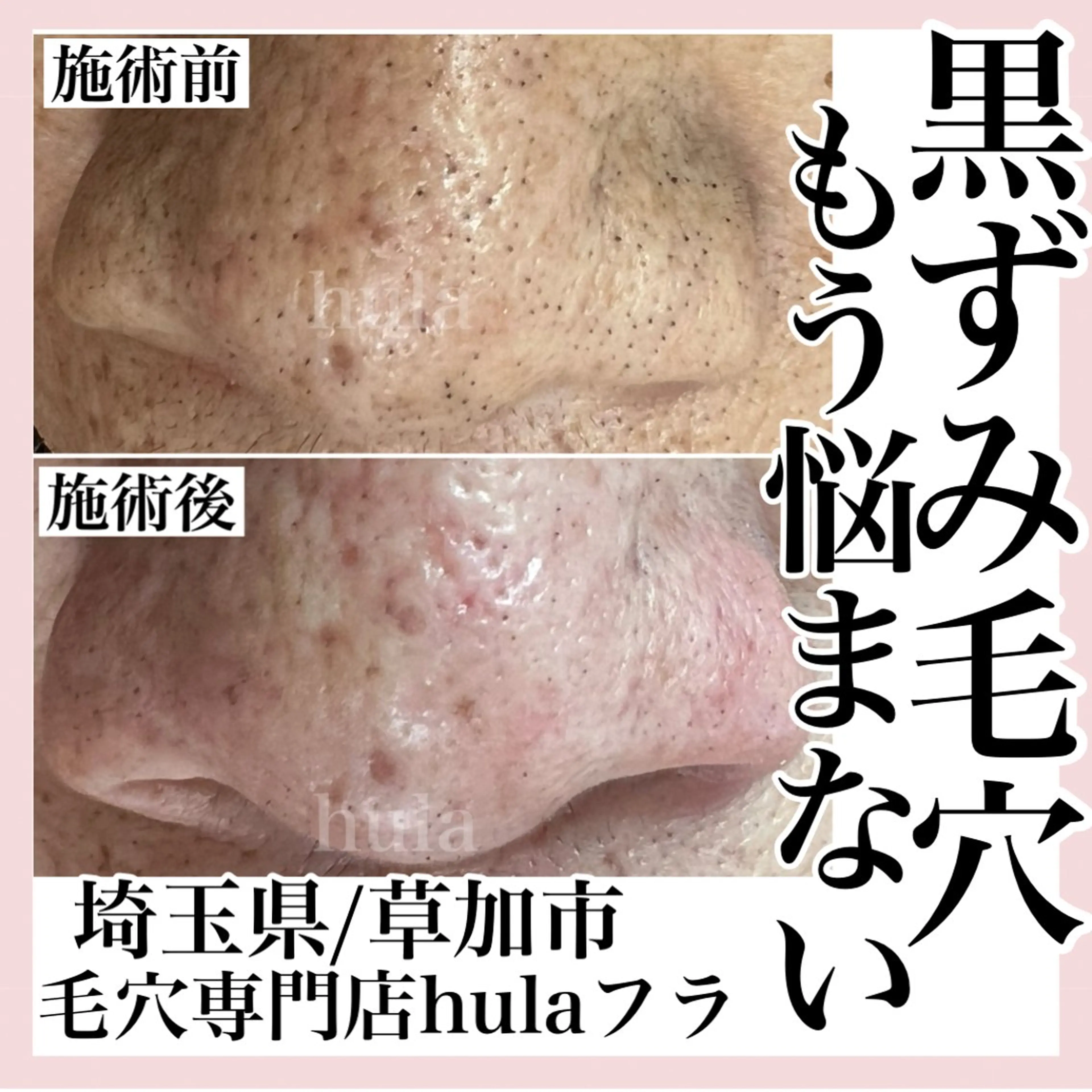 毛穴専門店hula 杉山智美のエステ・リラクイメージ