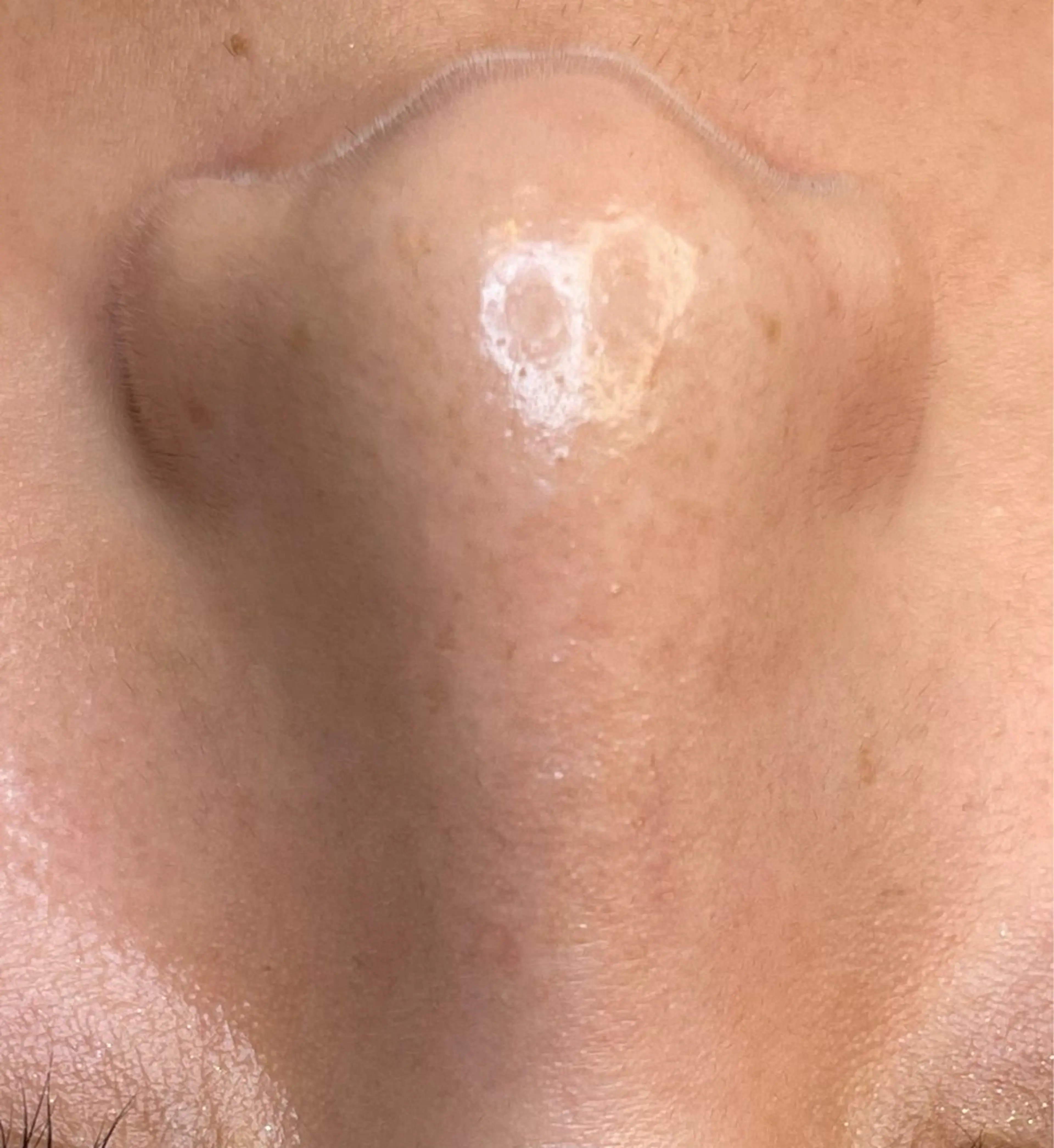 【韓国式3D毛穴洗浄×リジュラン】最強韓国肌管理セット❤️‍🔥韓国肌管理で人気なリジュランがサロンで受けられます✨の写真