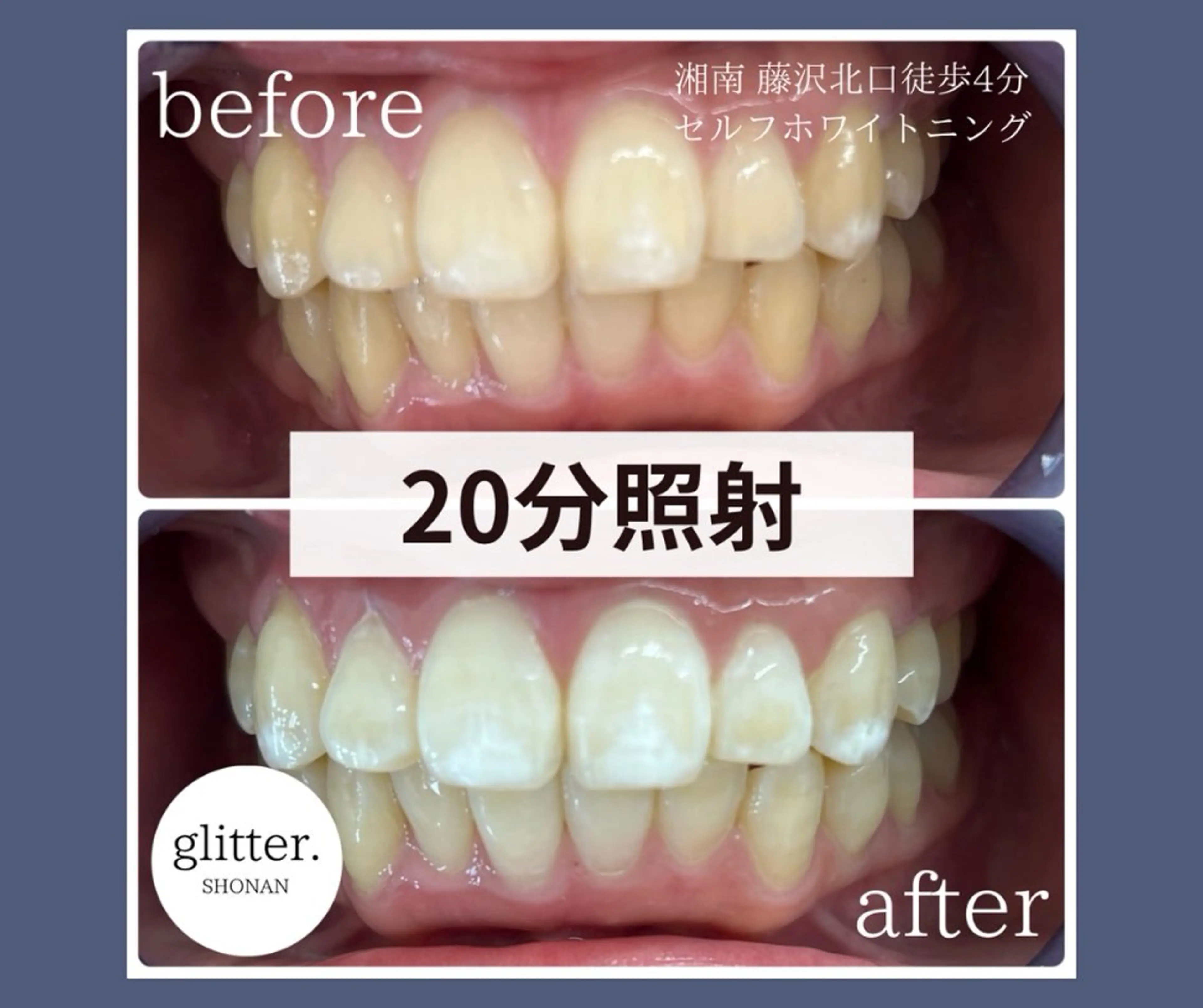 ネイル ホワイト glitter.SHONAN所属・ホワイトニング専門店 glitterのその他イメージ