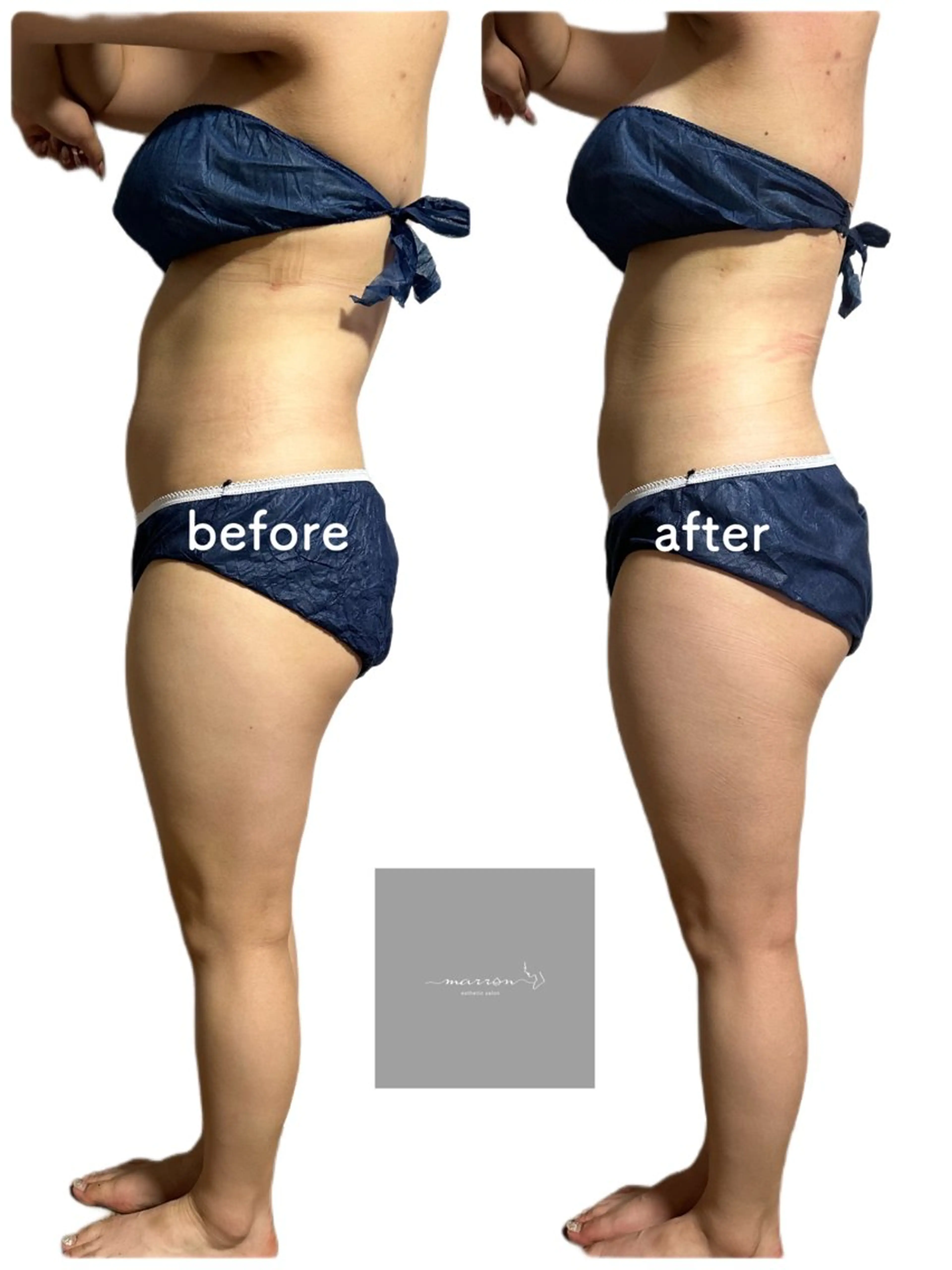 marron所属・痩身ハイパーナイフ ララピールリアボーテのエステ・リラクイメージ