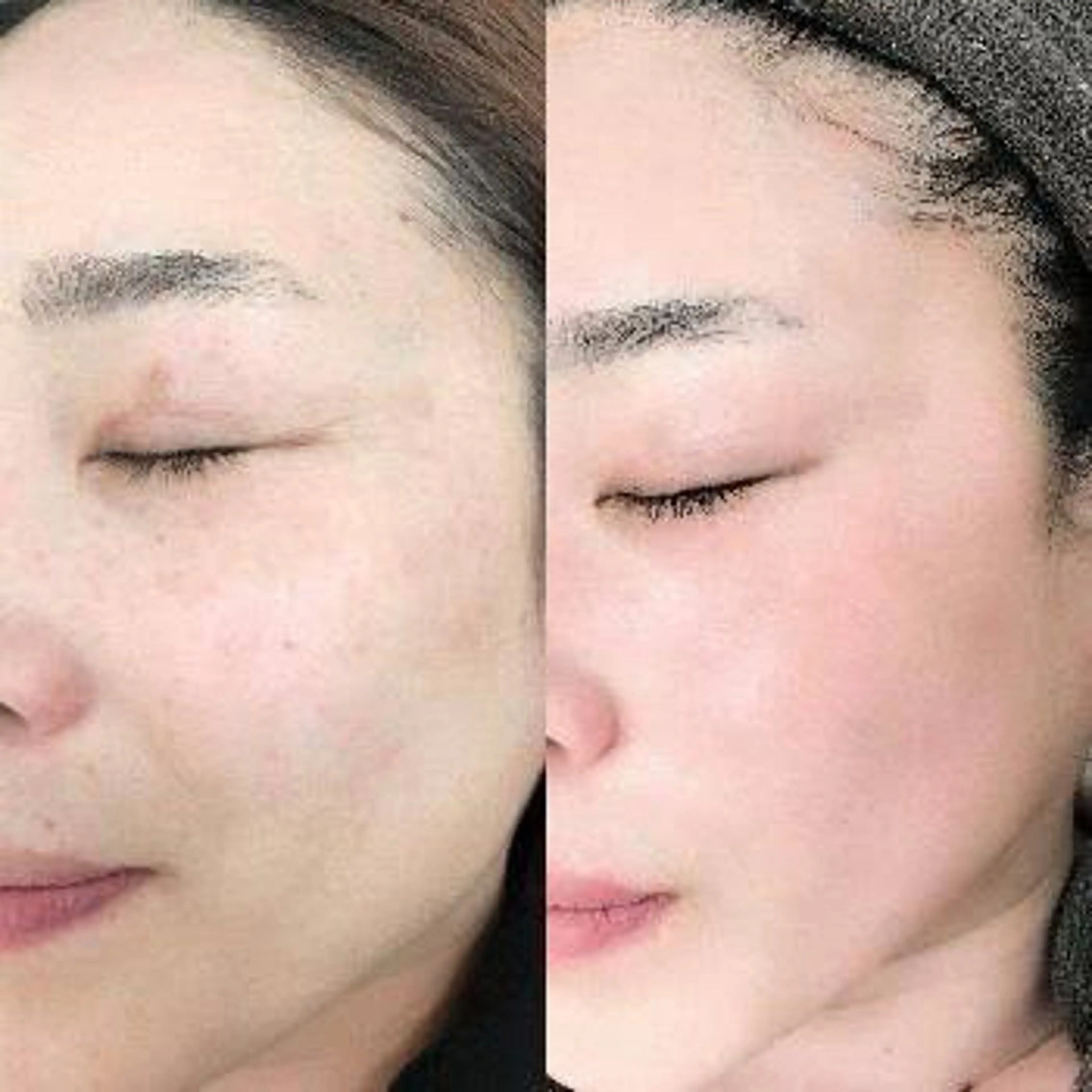 【シワ•たるみをなんとかしたい!】REVI次世代ハーブピーリング+バラ幹細胞/リフトアップ/300種類の天然ハーブ🌿の写真