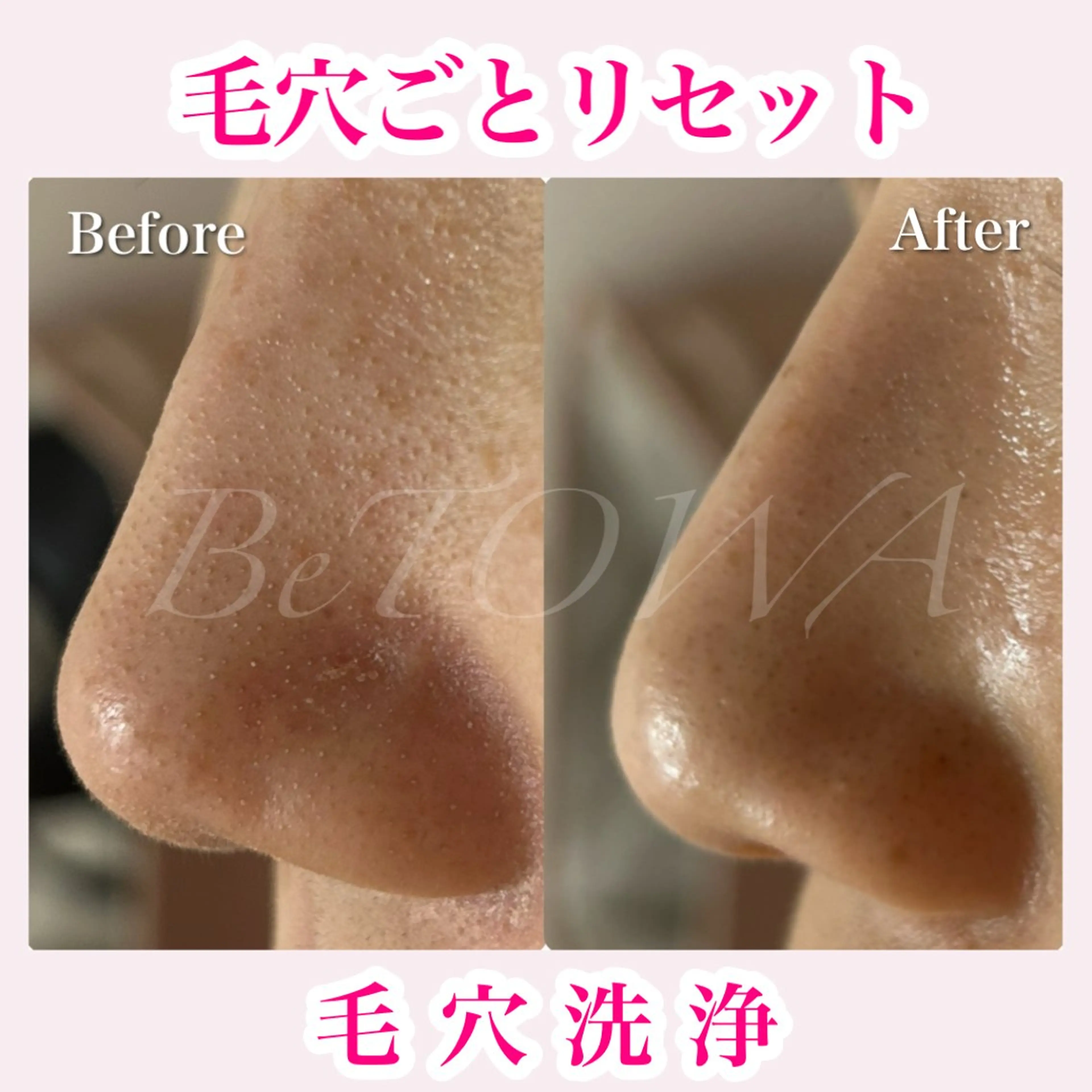 エステ BeTOWA所属・BeTOWA 毛穴洗浄／Wax脱毛のエステ・リラクイメージ