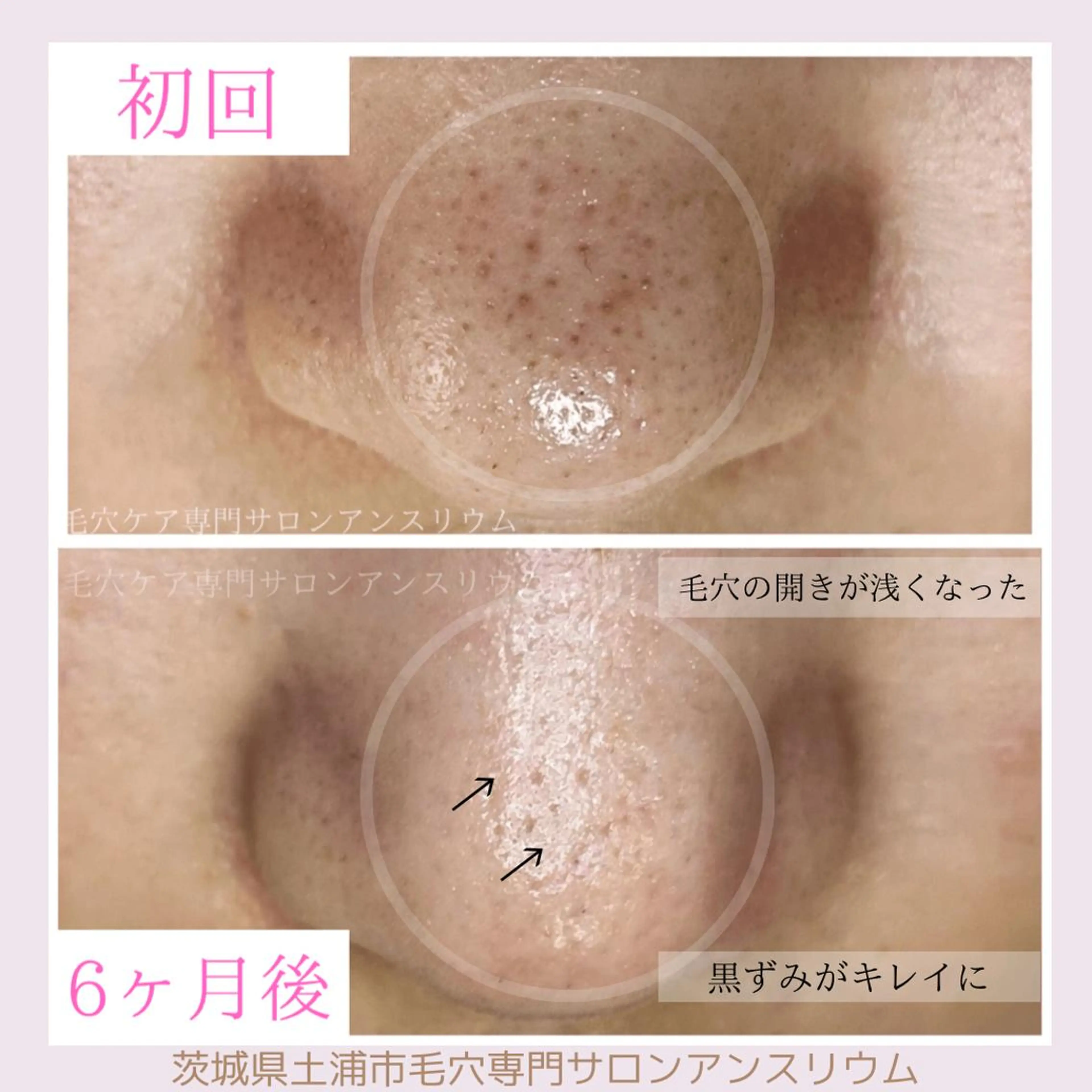 毛穴ケア専門サロンアンスリウム所属・茨城土浦 つくば毛穴 ケア専門サロンのエステ・リラクイメージ