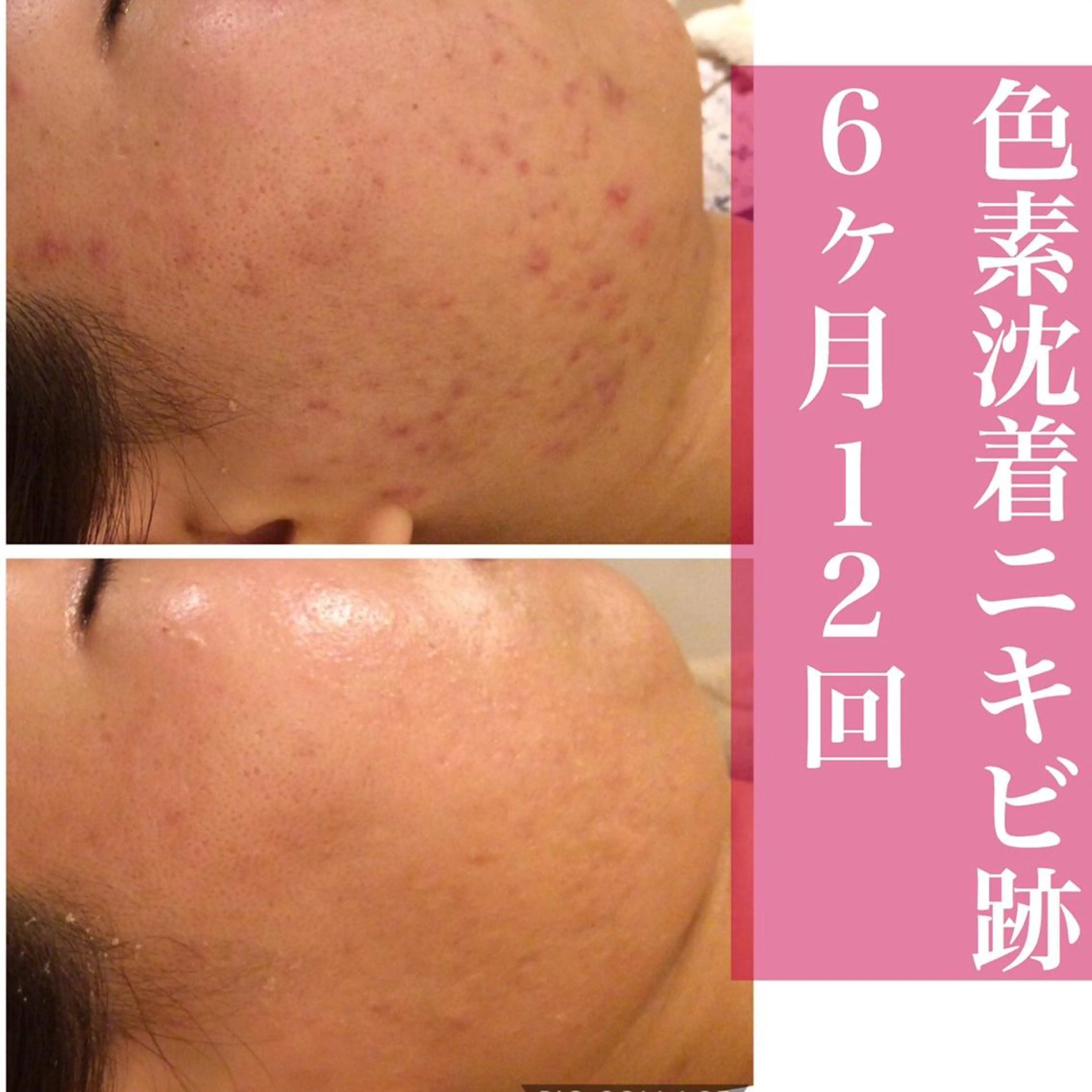 ミディアム カラー パーマ ヘアアレンジ メンズ キッズ ネイル マツエク・マツパ アイブロウ エステ リラク ニキビ・肌質改善専門 ♡人生が変わるサロンのエステ・リラクイメージ