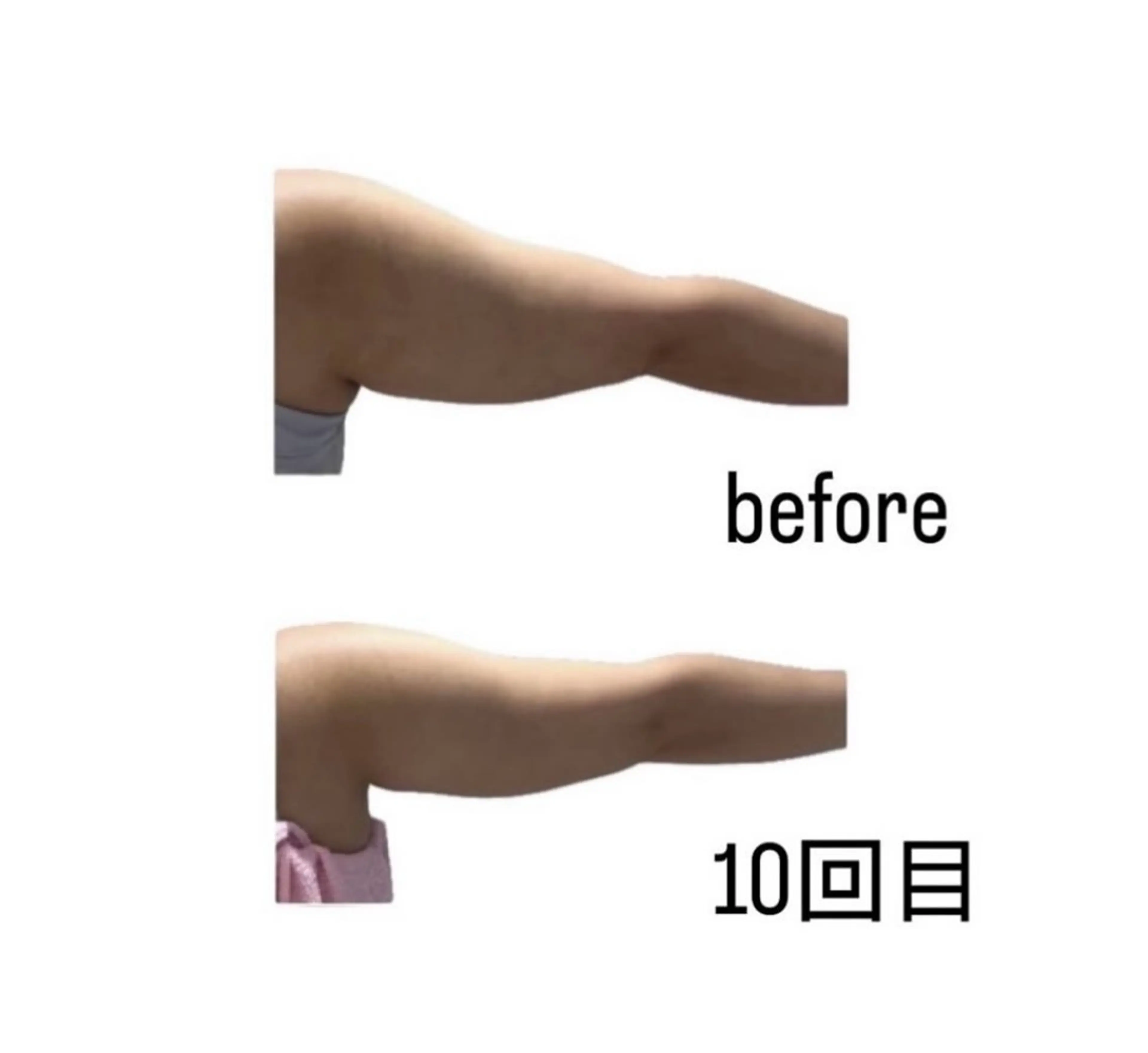 結果重視‼︎マイナス12℃クールスカルプティング20カップ‼︎の写真