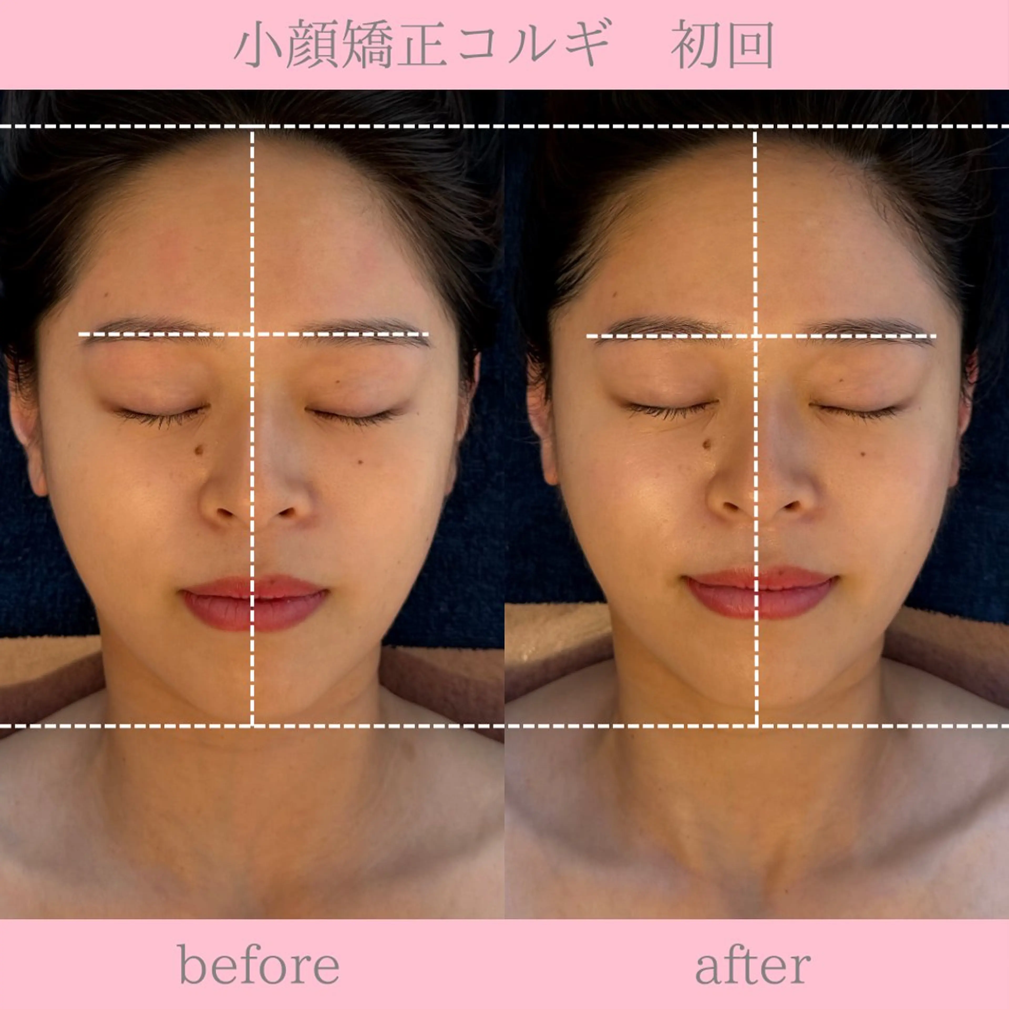ミニモ限定クーポン✺⋆*小顔矯正コルギ＋上半身マッサージ付🉐顔歪み矯正◎ほうれい線◎の写真