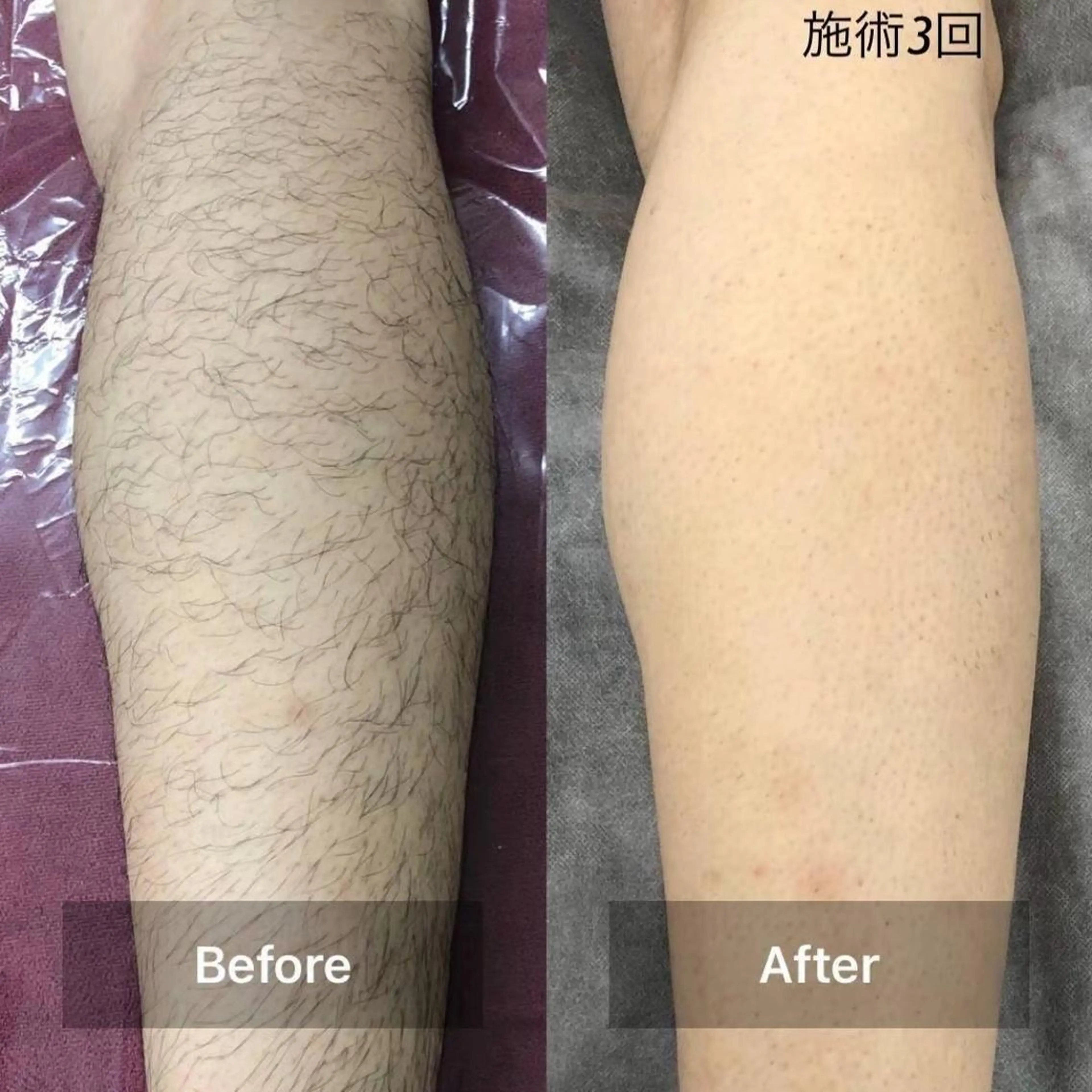 【メンズ】ご新規様😺顔なし全身のみ脱毛（VIO含む）の写真