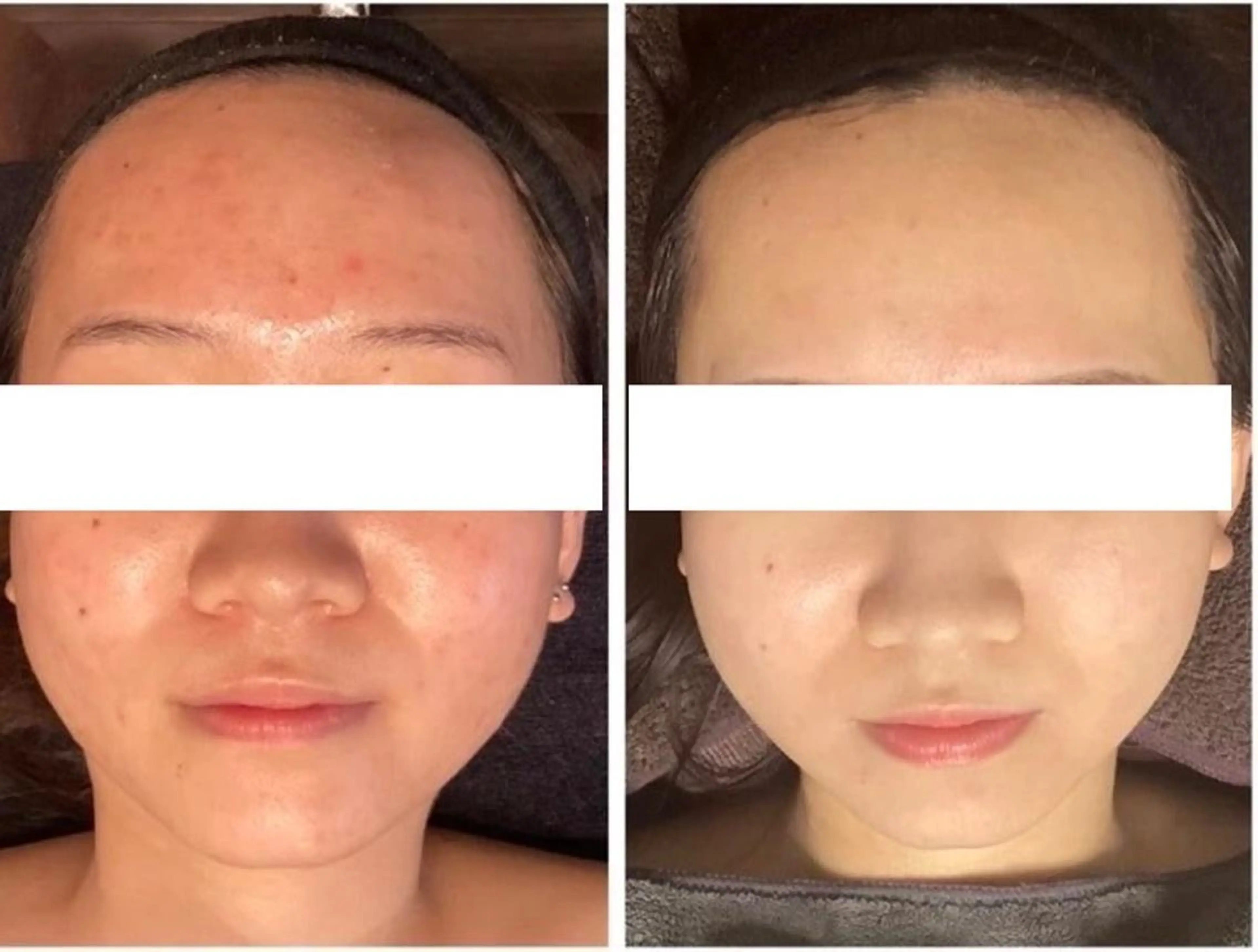 池袋毛穴ニキビ改善 ハーブピーリングのエステ・リラクイメージ