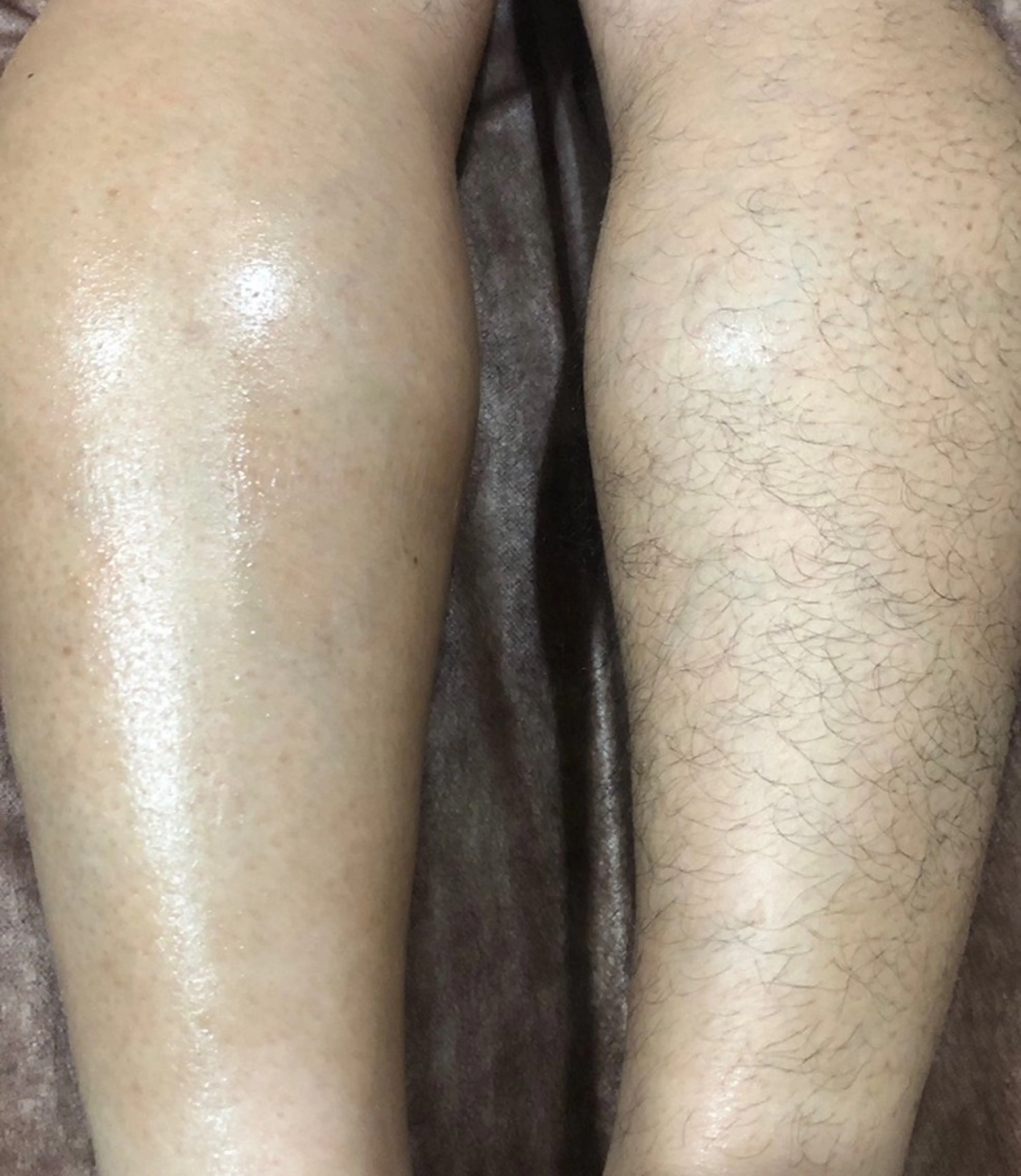 【メンズ】Mパーツ　ワックスもしくは光脱毛の写真