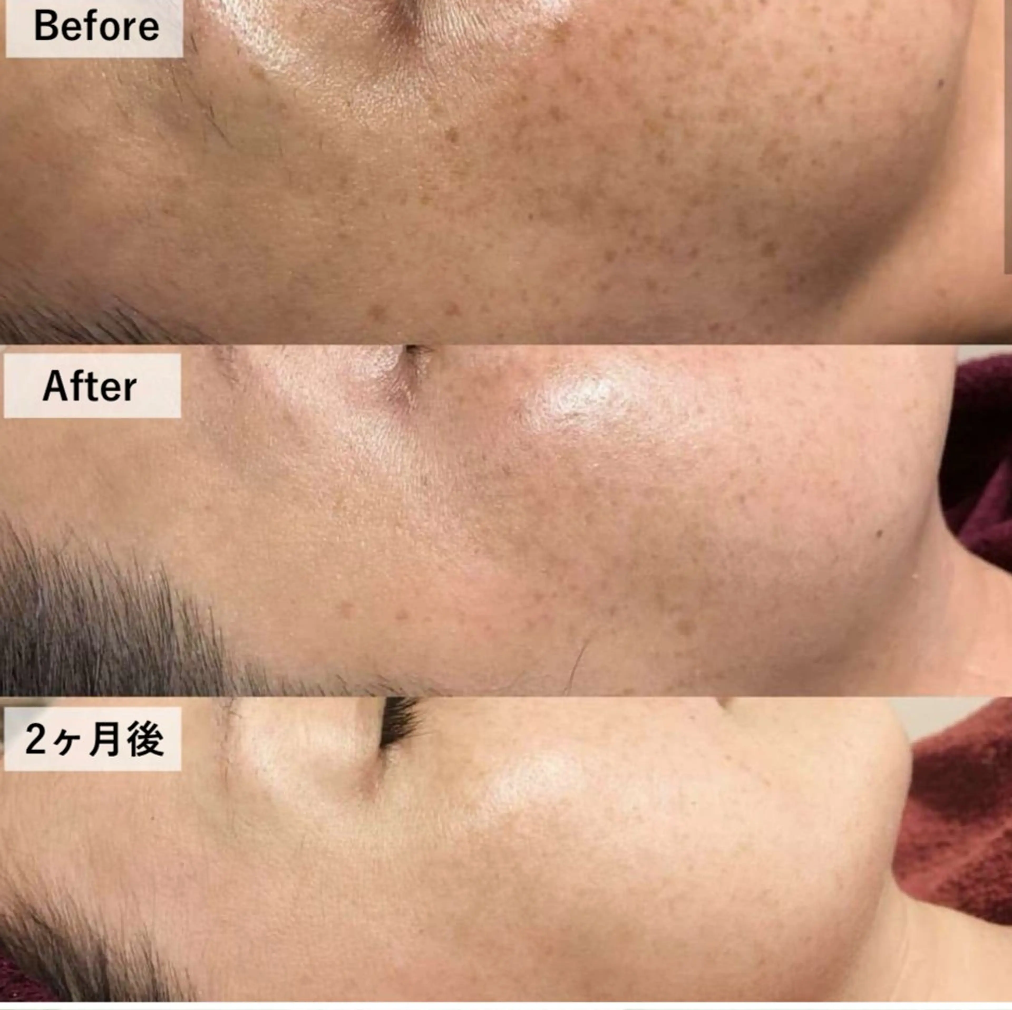 肌を育てる次世代型肌質改善ハーブトリートメント🌿【1月末までの特別価格】の写真