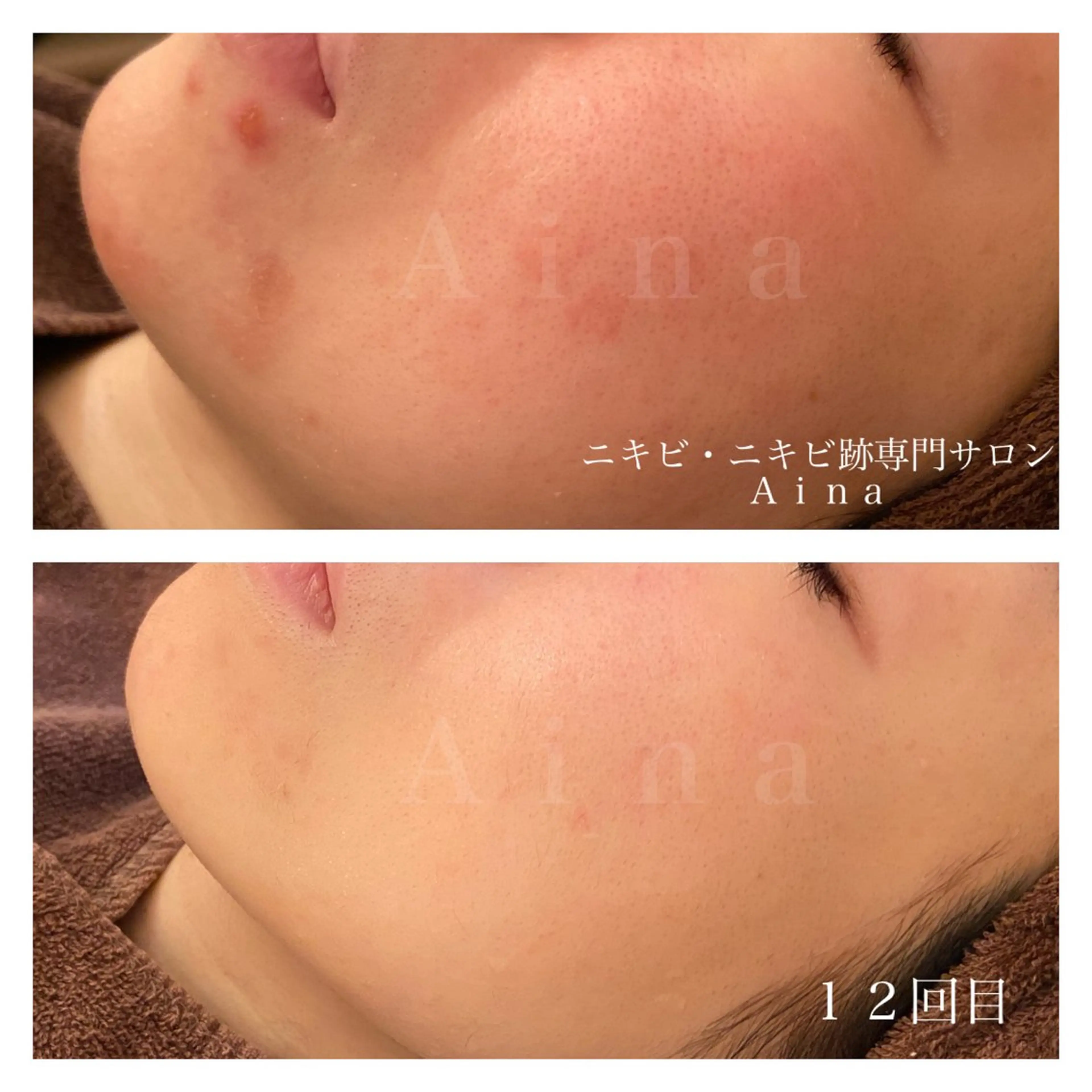 エステ リラク ニキビ跡専門サロン Ainaのエステ・リラクイメージ