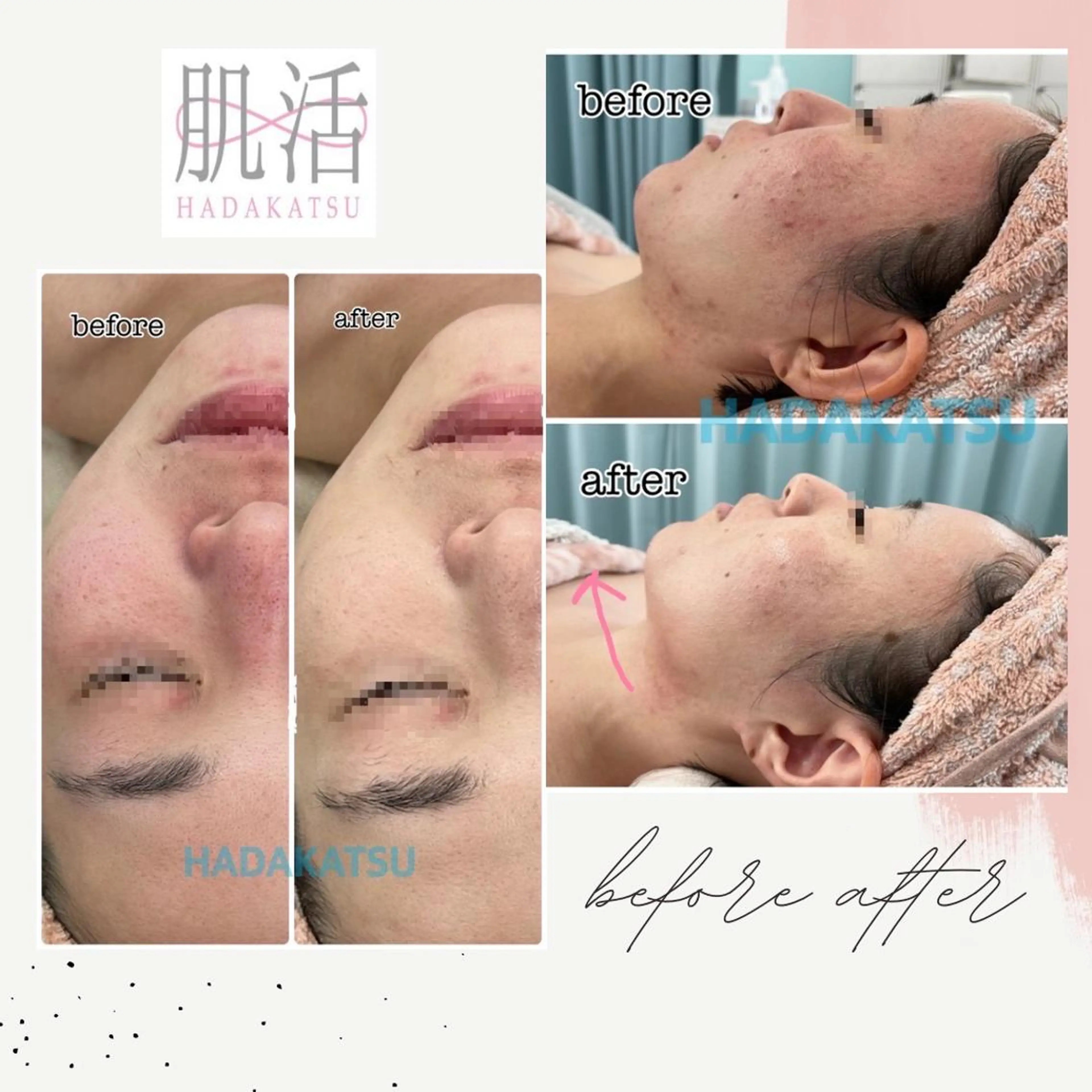 【肌活6周年キャンペーン】フォトRFフェイシャル＋ヒト幹細胞導入！！毛穴レスへ✨小顔美容液仕上げ✨️の写真