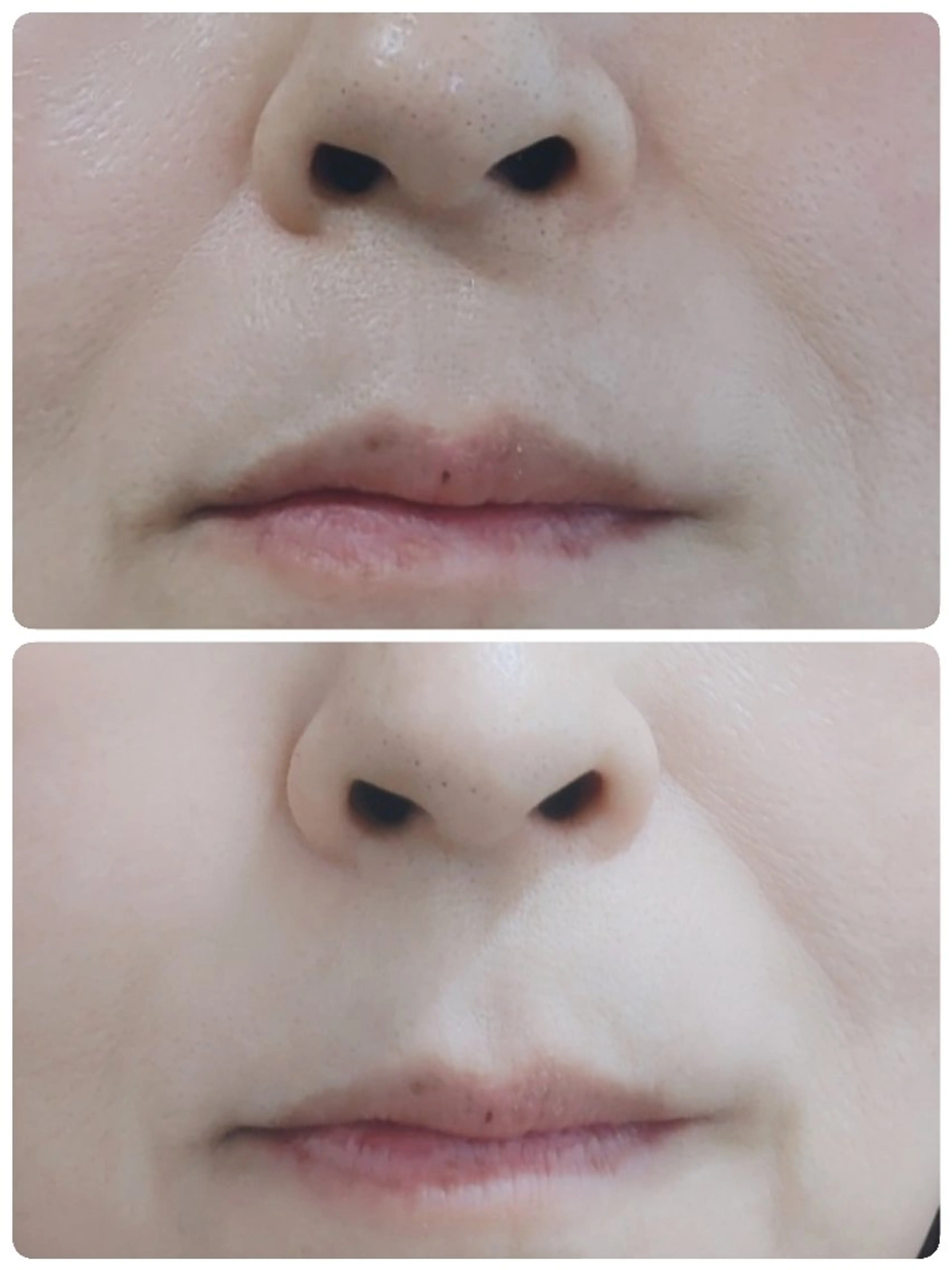 角質・毛穴洗浄🌼 脱毛🌸嶋津弘美のエステ・リラクイメージ