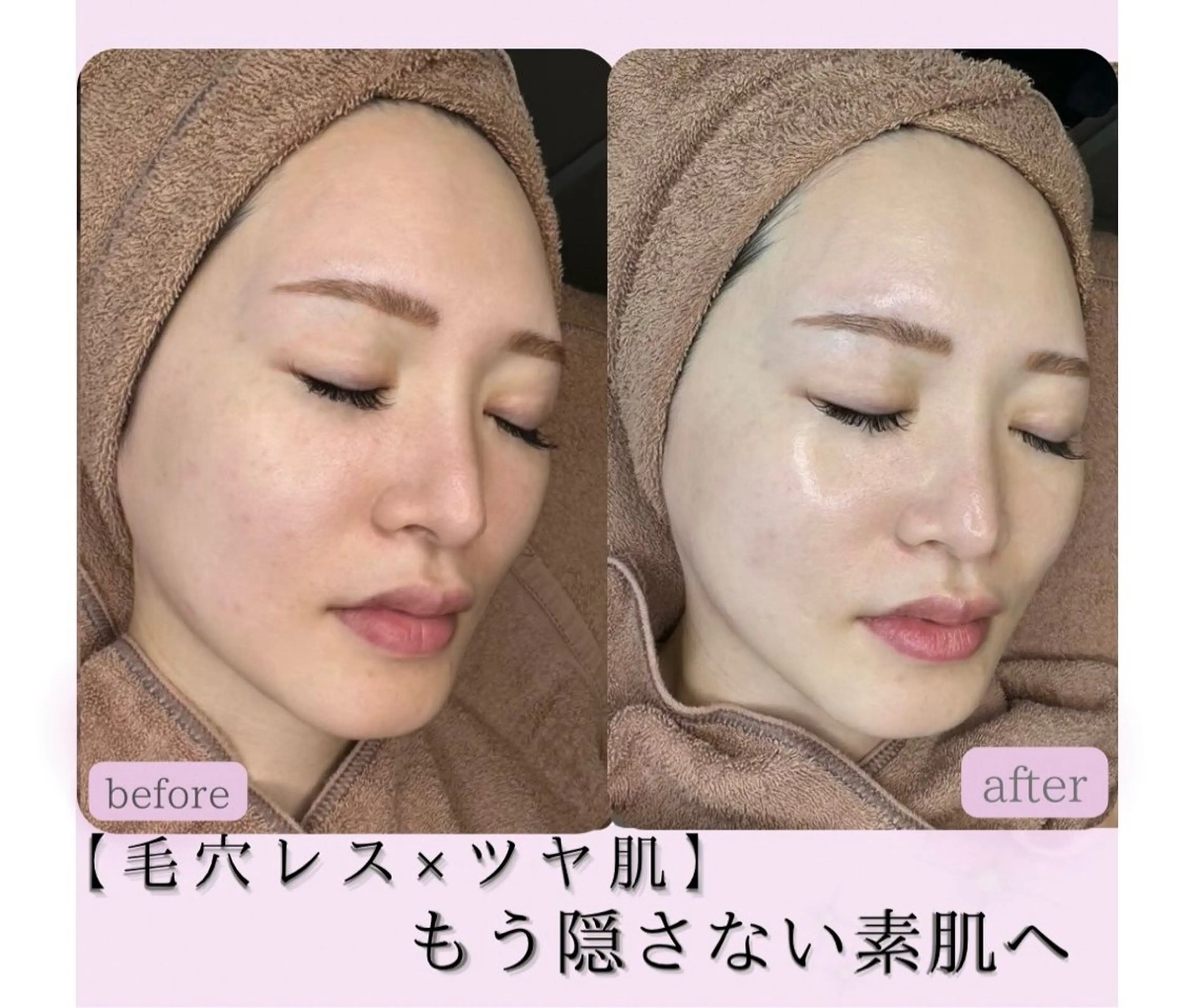 【最新韓国式肌管理】ツヤ肌ララピール全顔+毛穴洗浄の写真