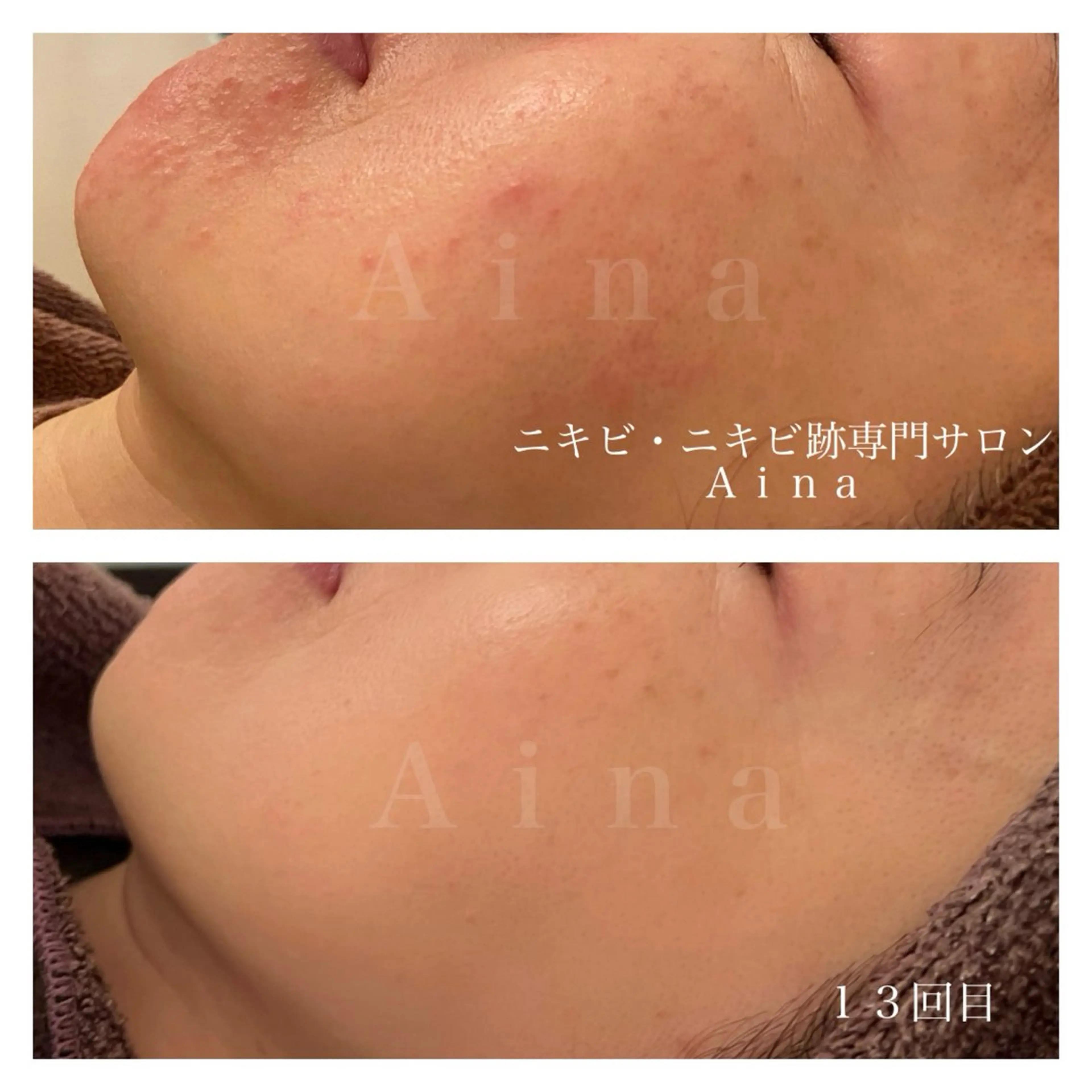 エステ リラク ニキビ跡専門サロン Ａｉｎａのエステ・リラクイメージ