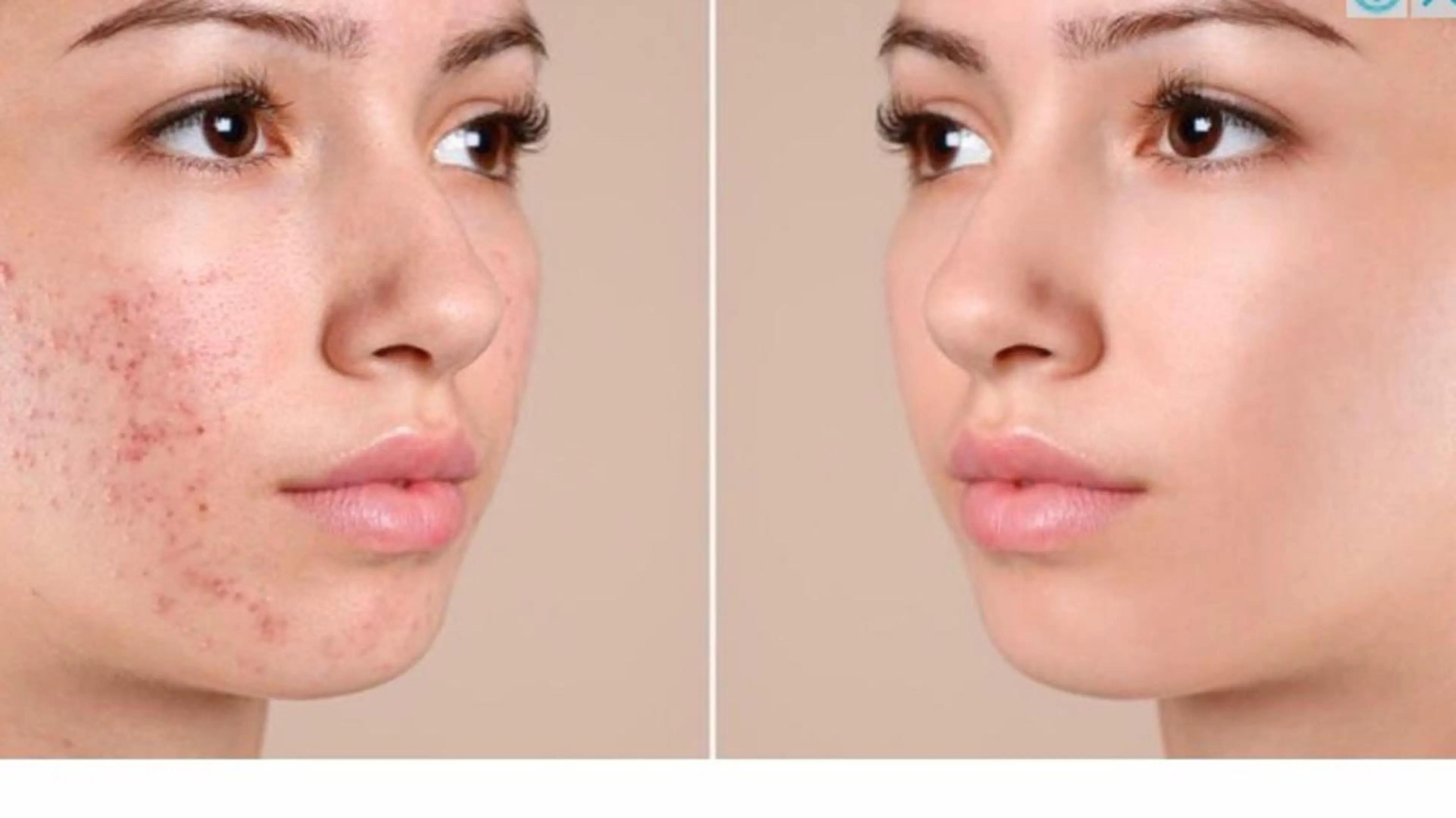 フォト光フェイシャルお試しの写真