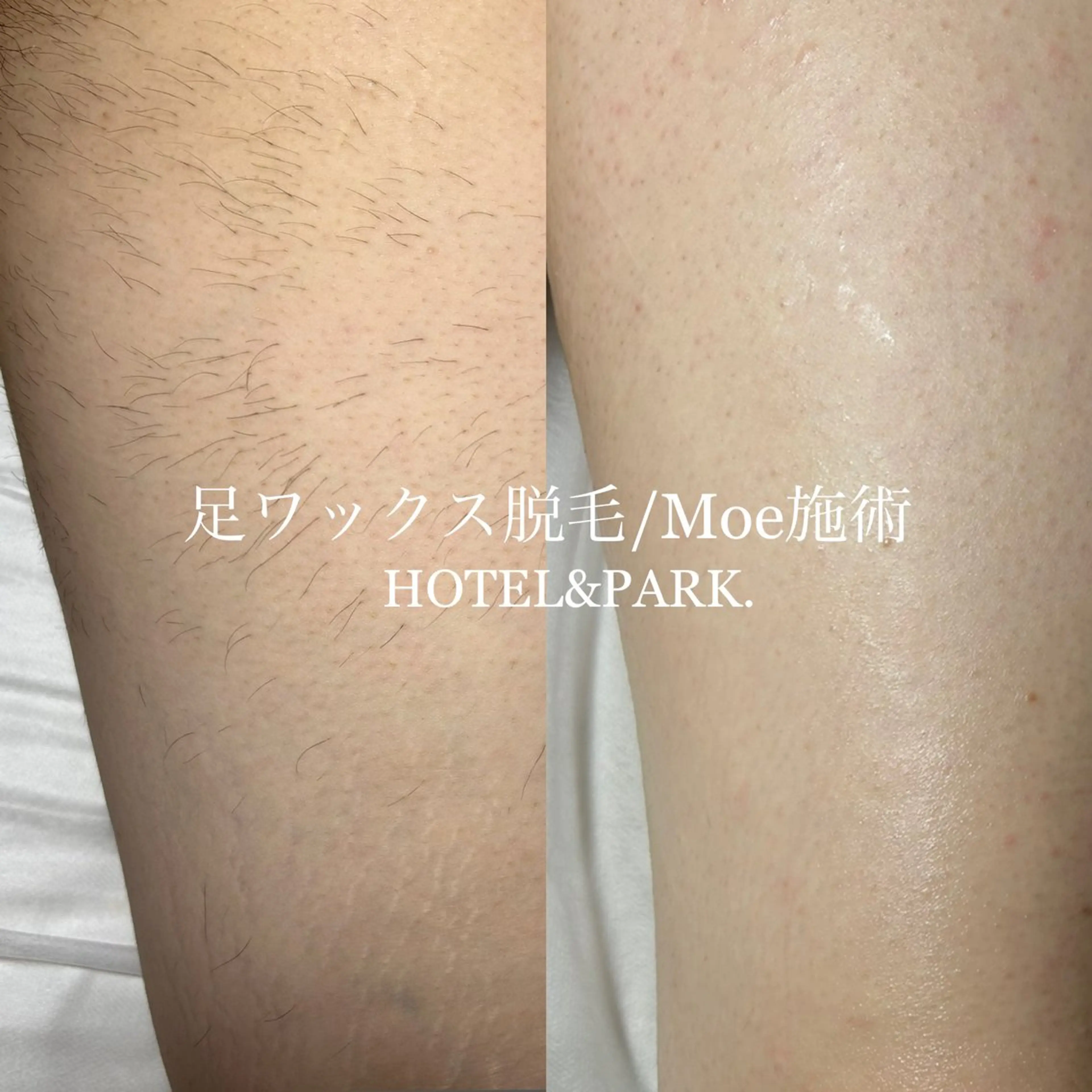 HOTEL&PARK .Moeワックス脱毛のエステ・リラクイメージ