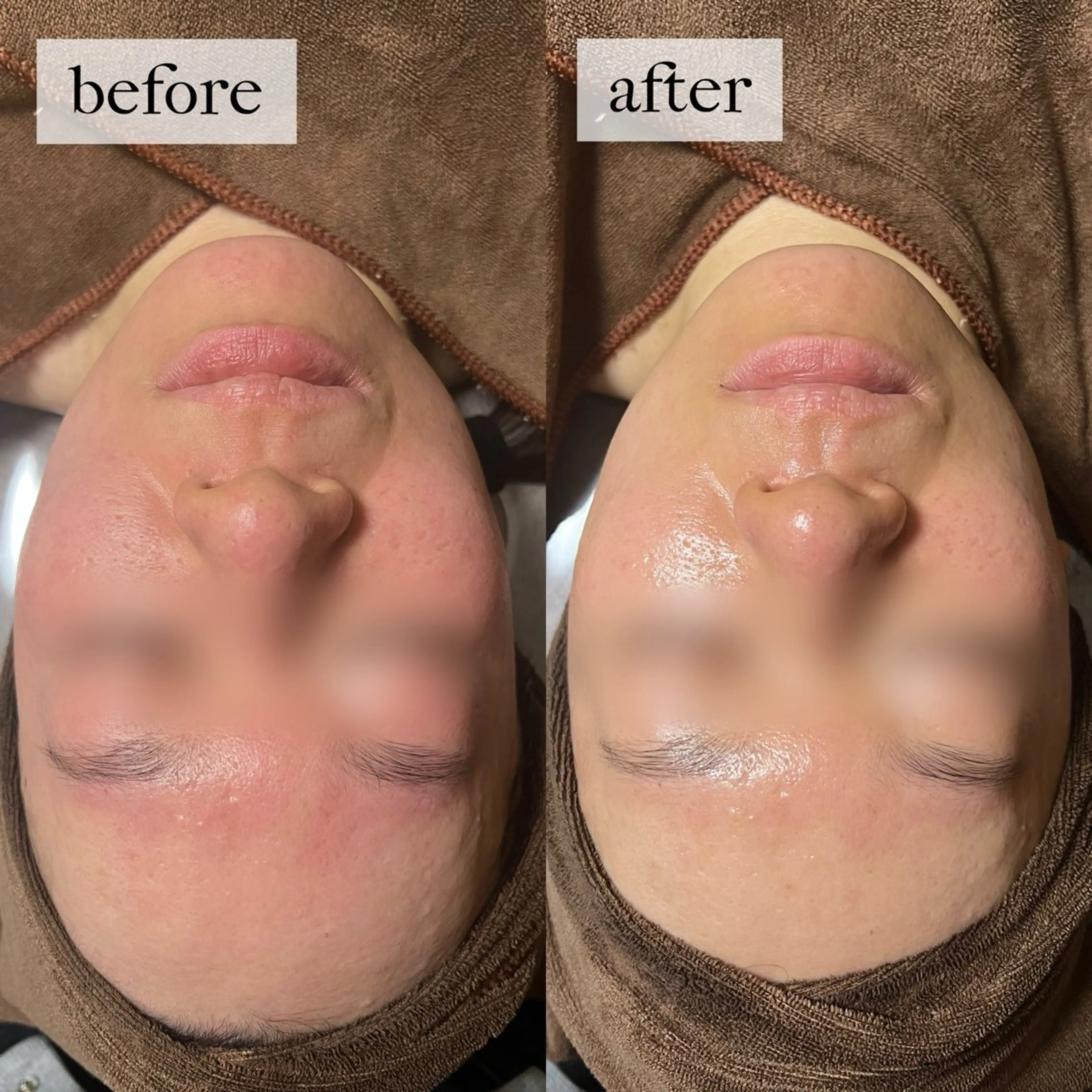 HINANO矢場町店【ヒナノ】所属・脱毛/肌改善🌿 HINANO 村田のエステ・リラクイメージ