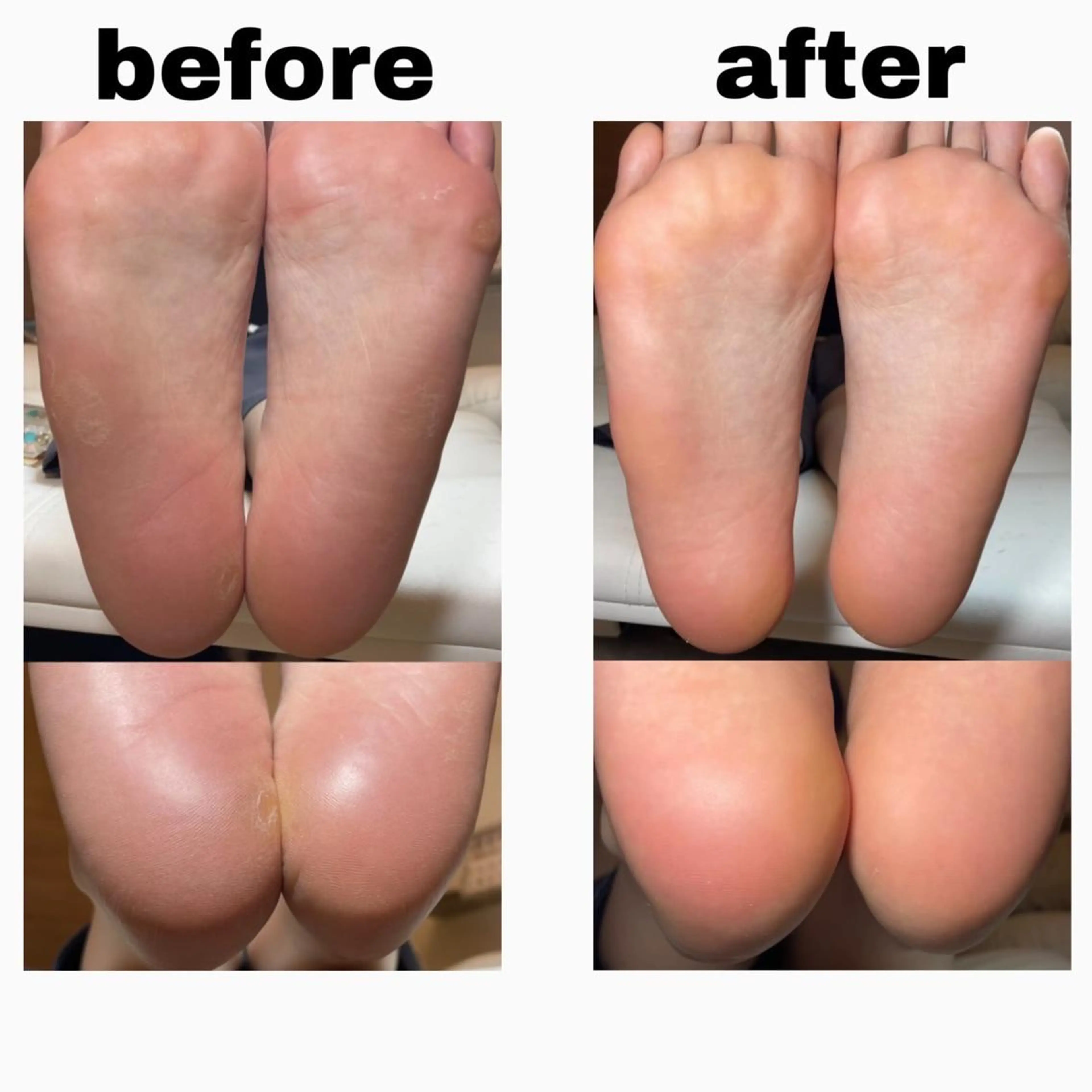 フット💜角質ケア✨角質ケアのみご予約の場合はこちら💕【フットバス付】の写真