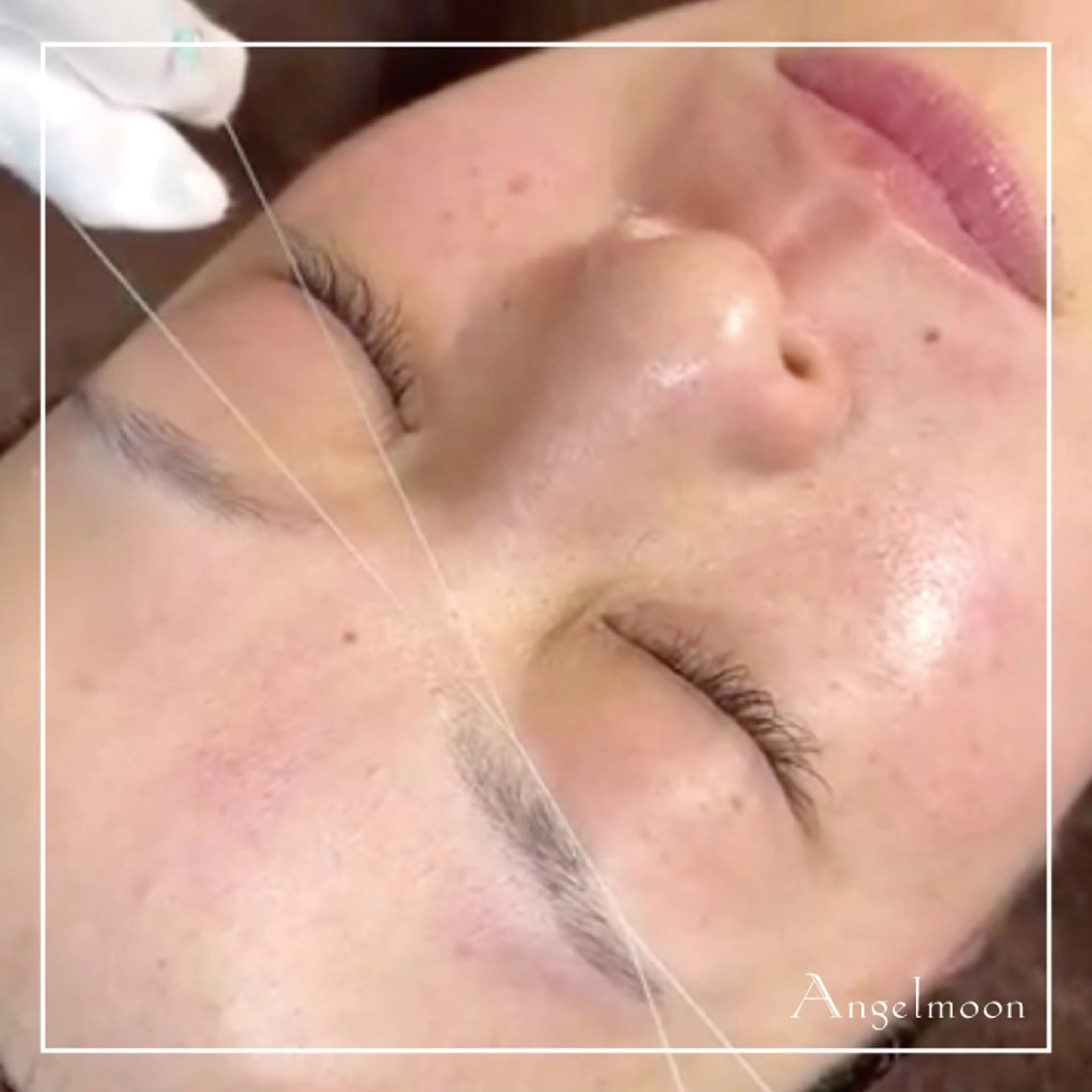 【モデル価格】シルク糸脱毛×酵素フェイシャルエステの写真