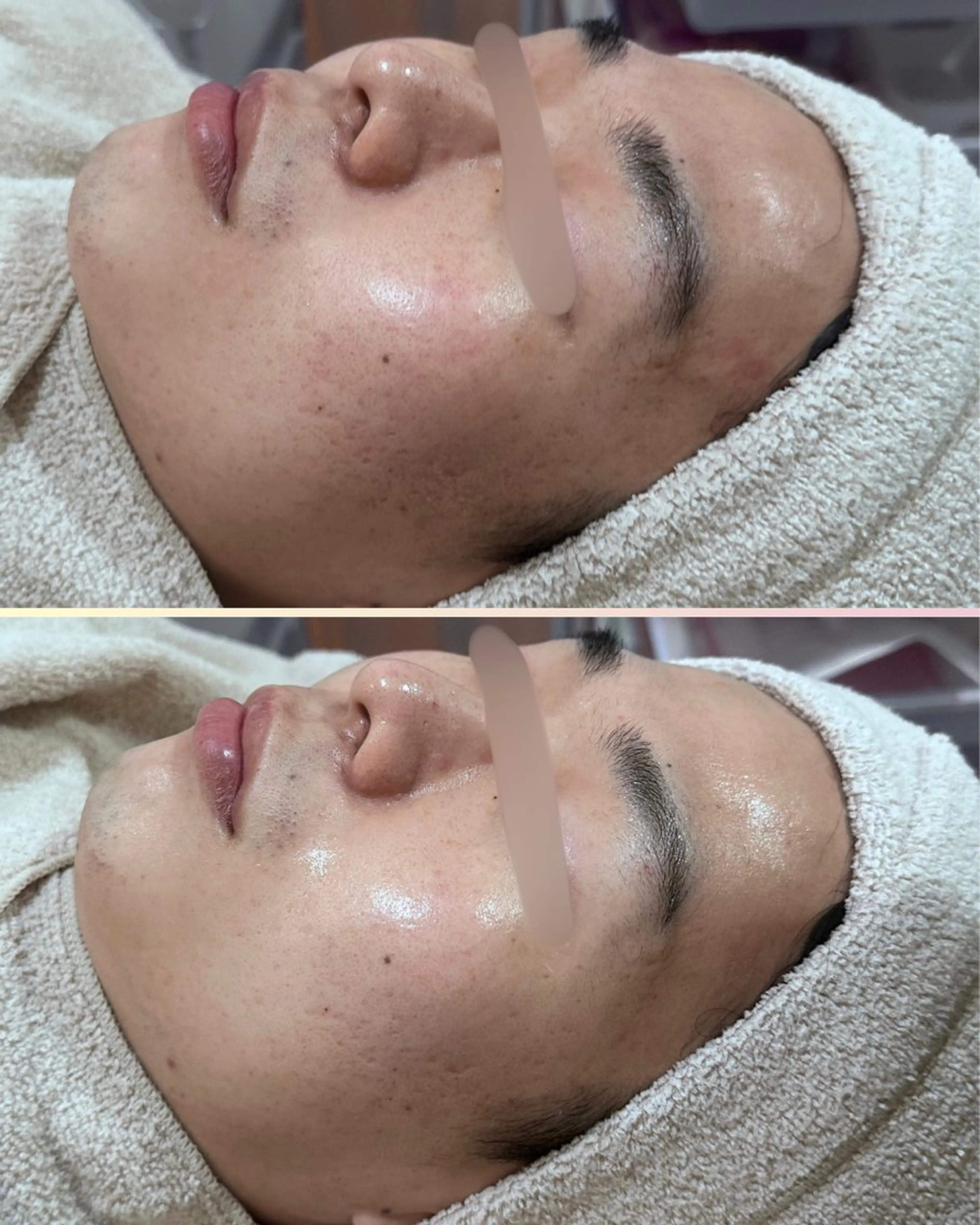 エステ |ピーリング・毛穴| soina神楽坂のエステ・リラクイメージ