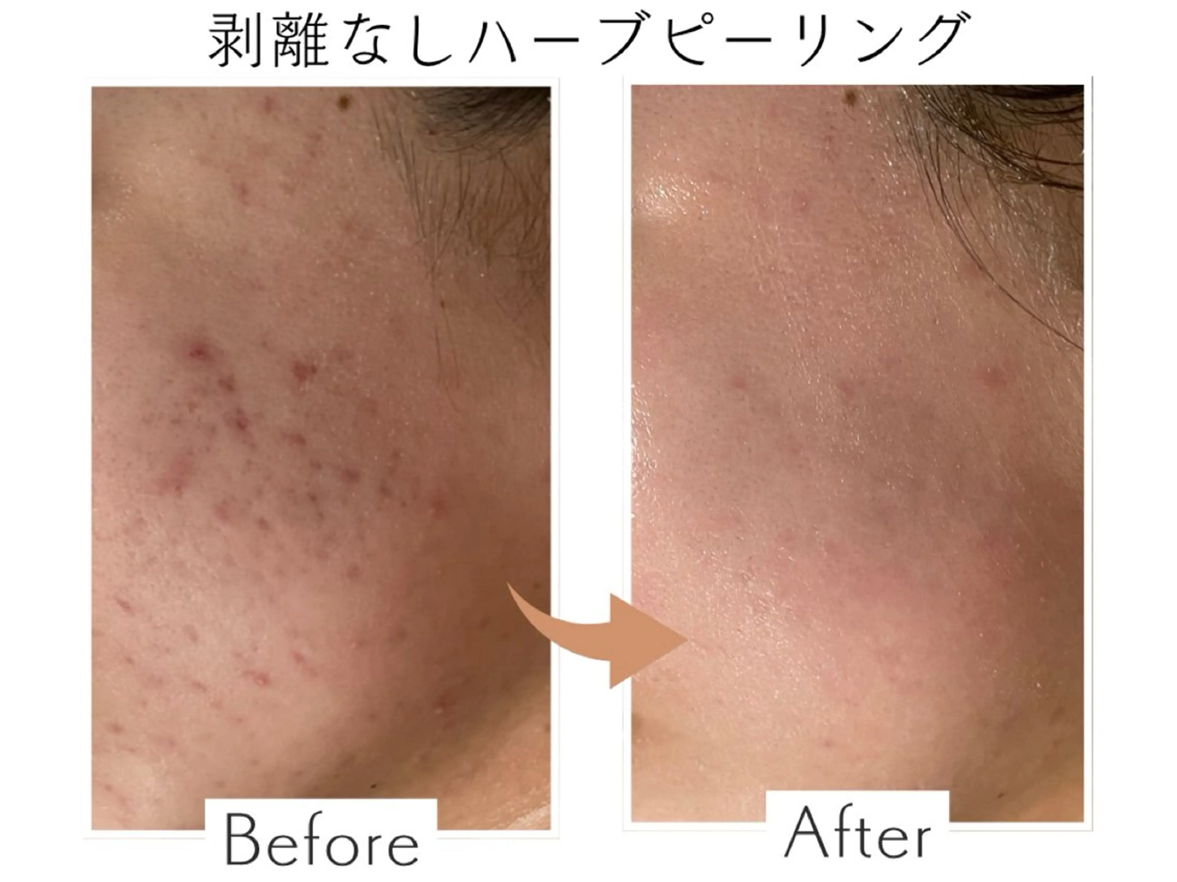 【リピート】剥離なし✨ハーブピーリング🌿🇰🇷の写真