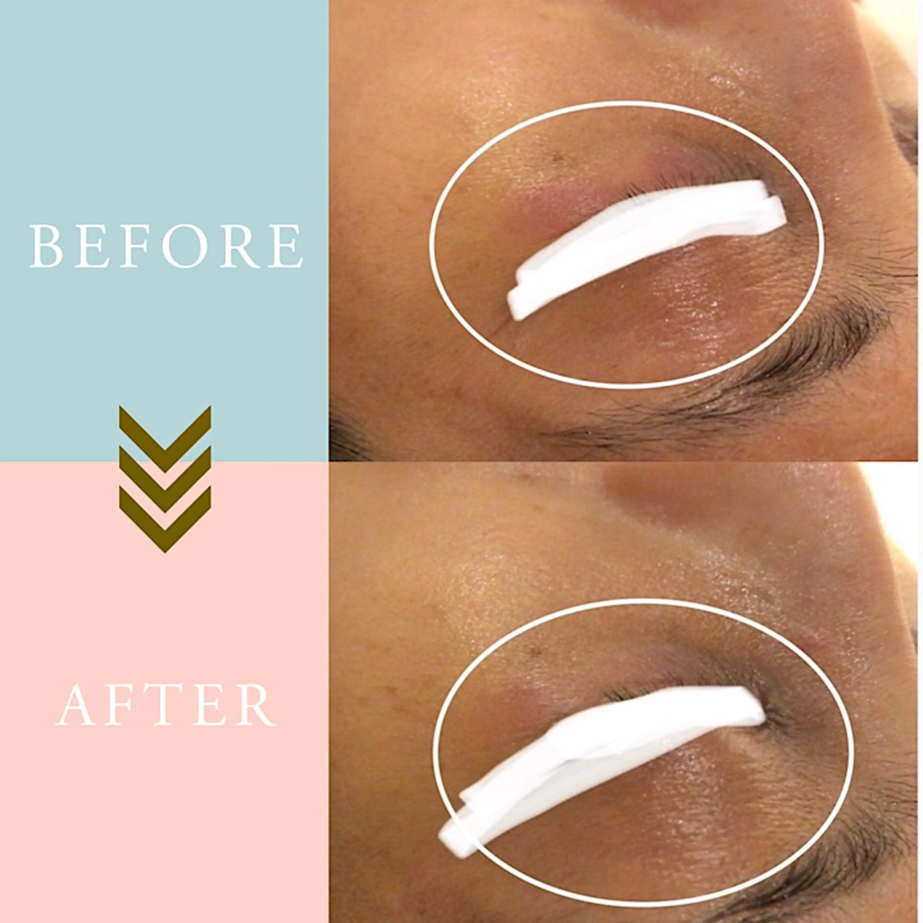 ニキビケア/毛穴/ 赤み/自信の肌✨森園のエステ・リラクイメージ