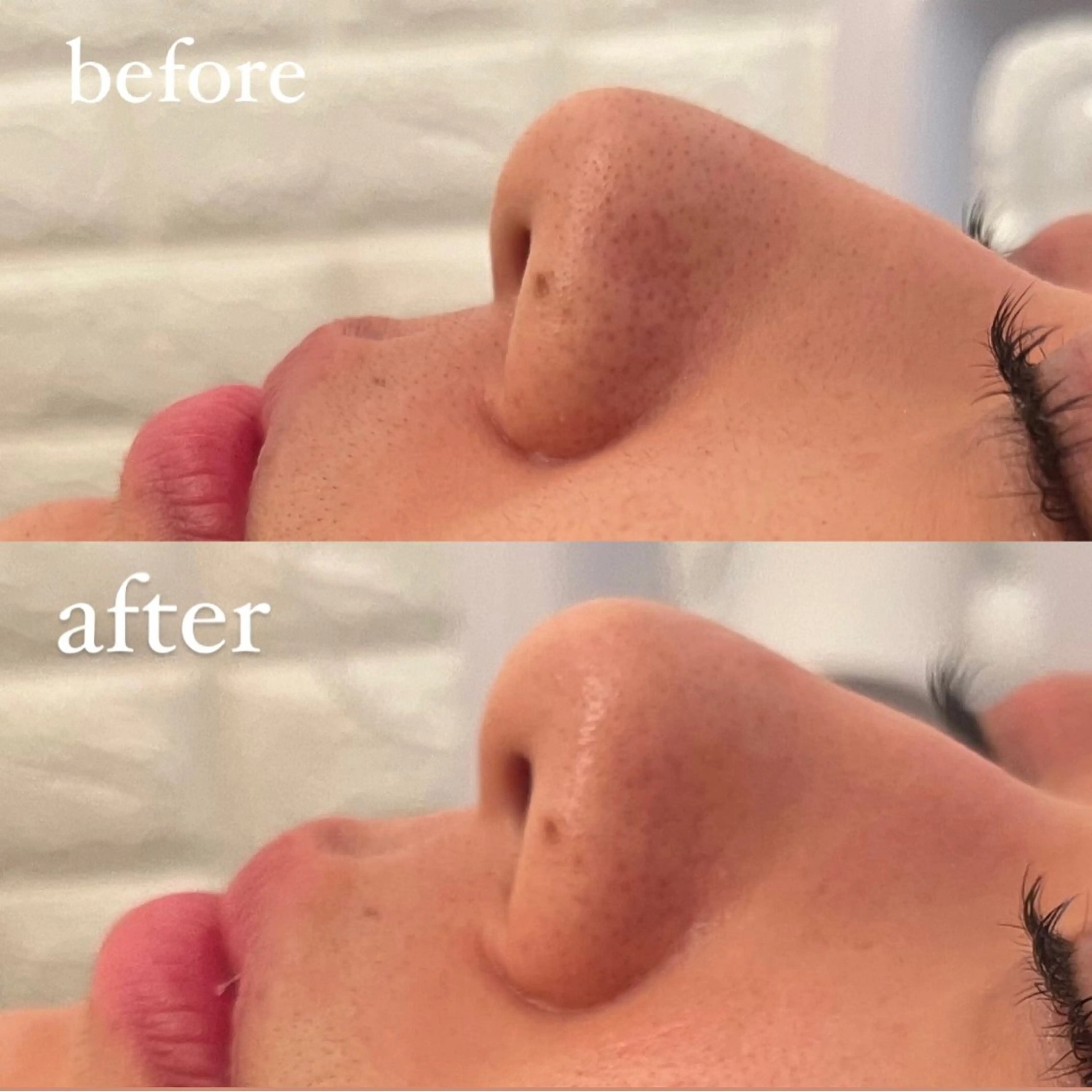 毛穴ケア/毛穴診断/ 毛穴洗浄〔心斎橋〕のエステ・リラクイメージ