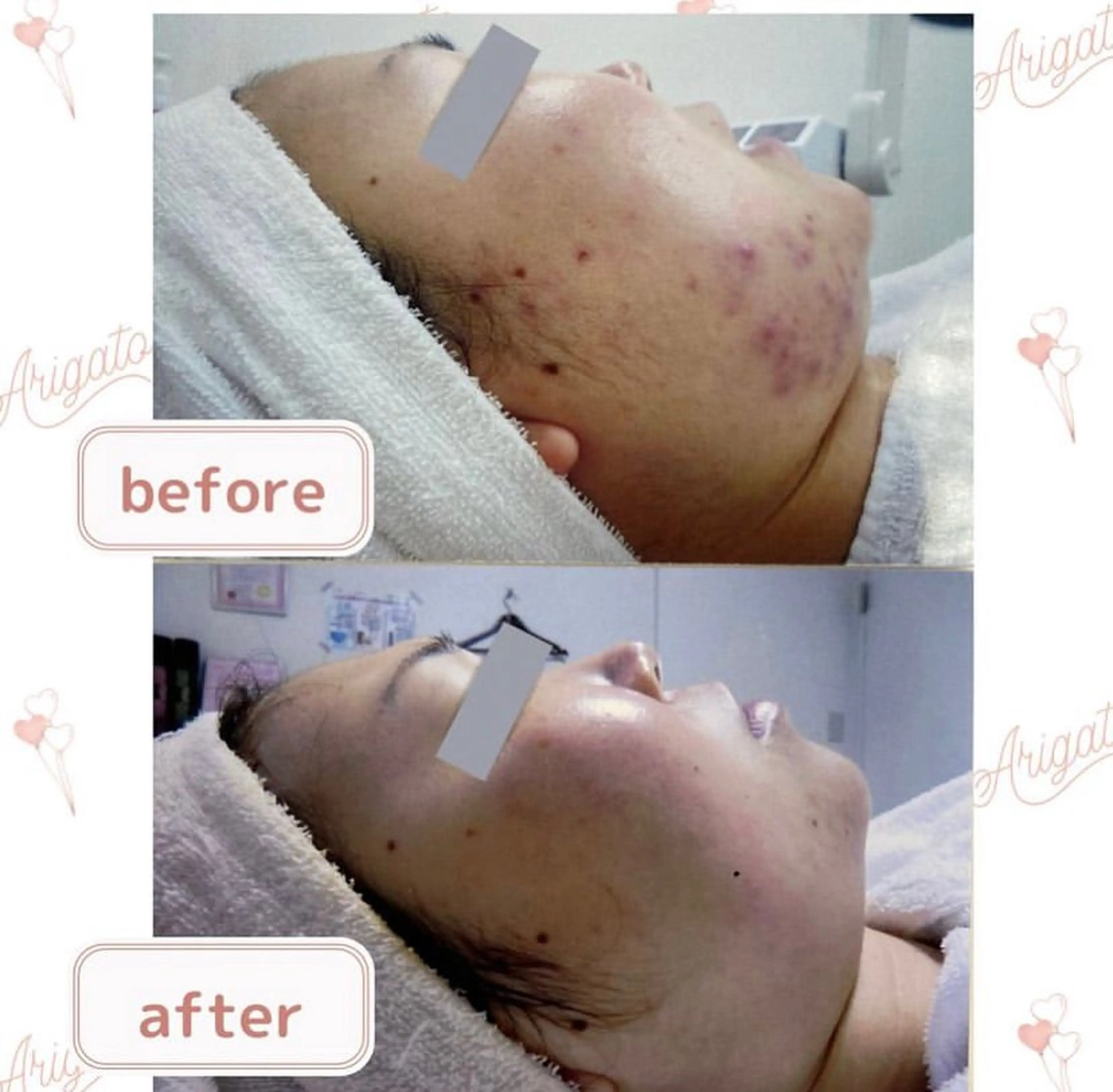 《長年の悩みのニキビ跡！根本からケアで憧れの陶器肌に☆》ニキビ跡ケア！フェイシャル２回体験　[大阪城北詰駅/京橋駅]の写真