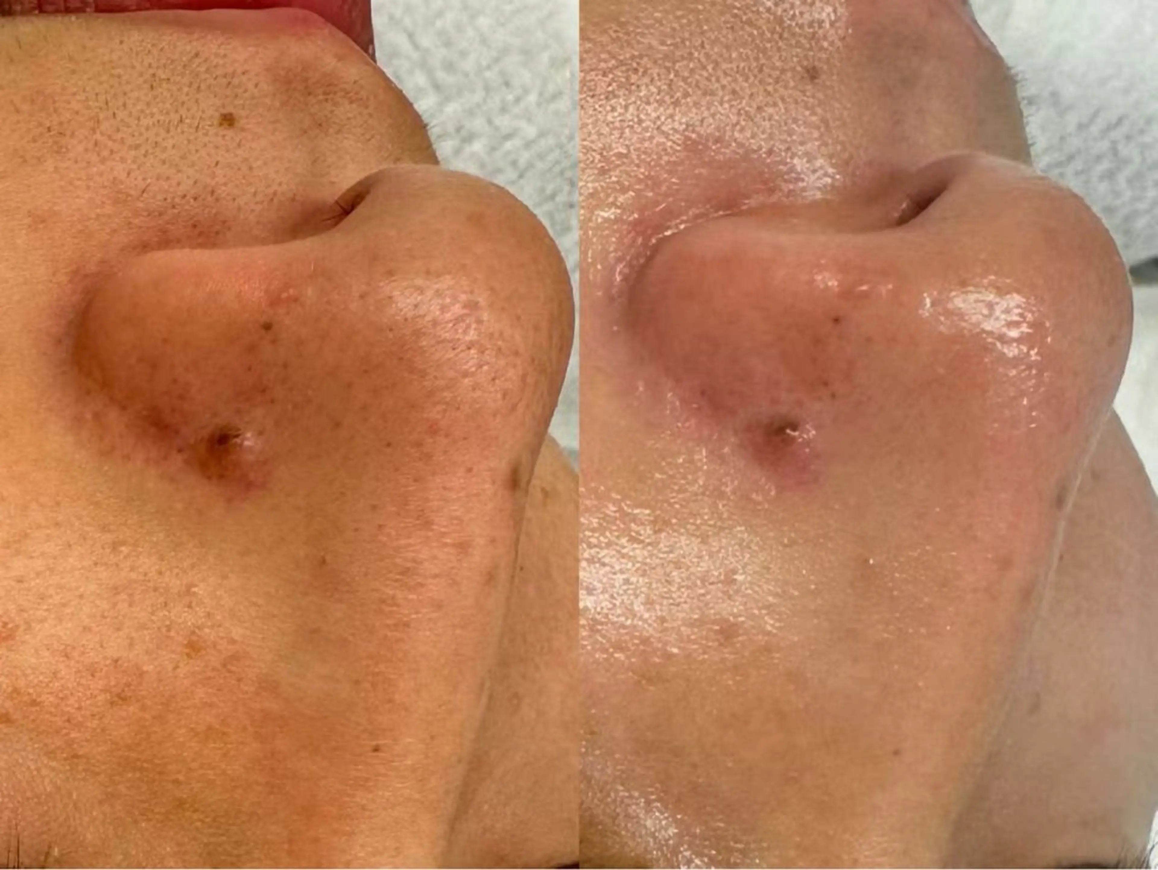 洗顔サロン池袋 毛穴洗浄のその他イメージ