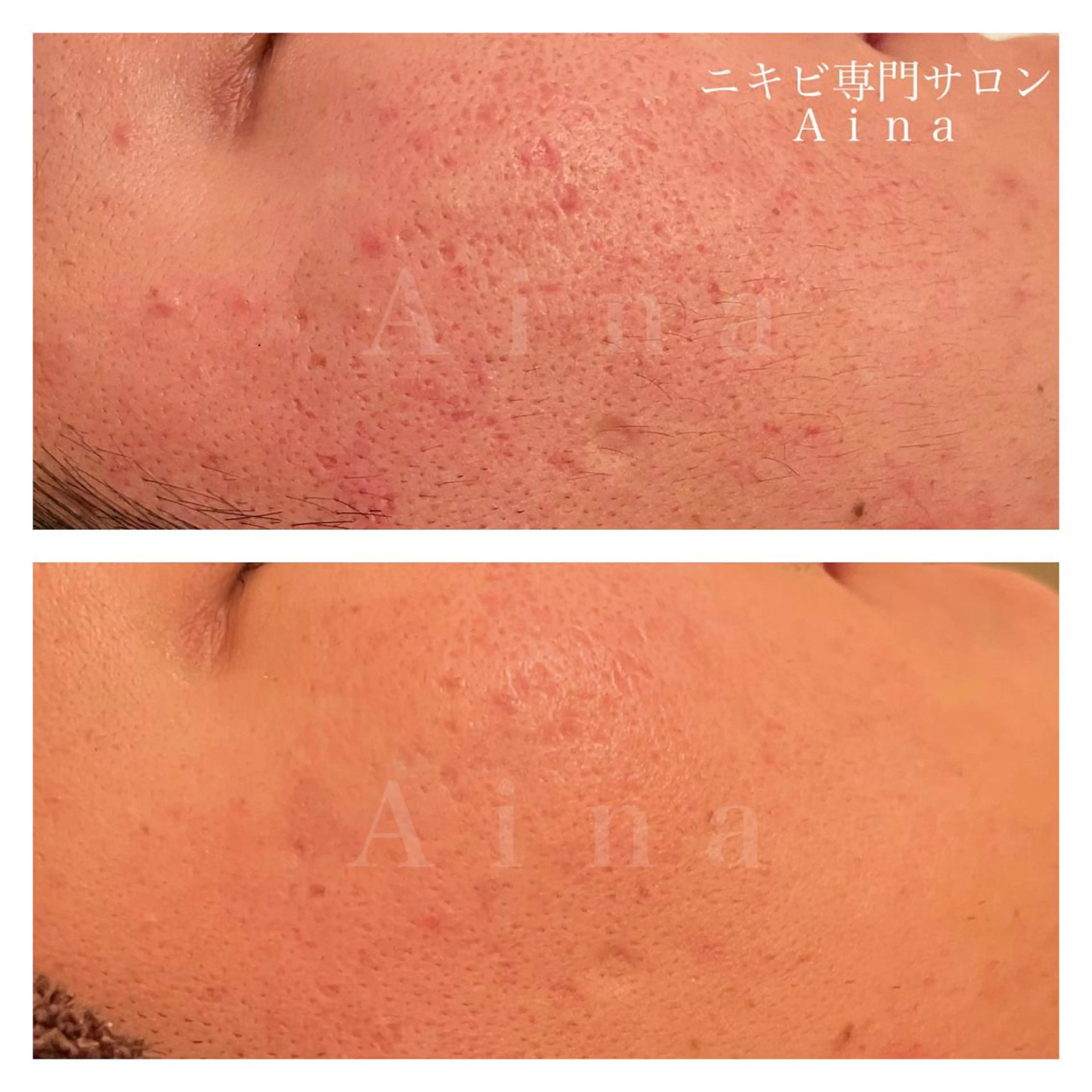 ミディアム カラー パーマ ヘアアレンジ メンズ キッズ ネイル マツエク・マツパ アイブロウ ニキビ跡専門サロン Ainaのエステ・リラクイメージ