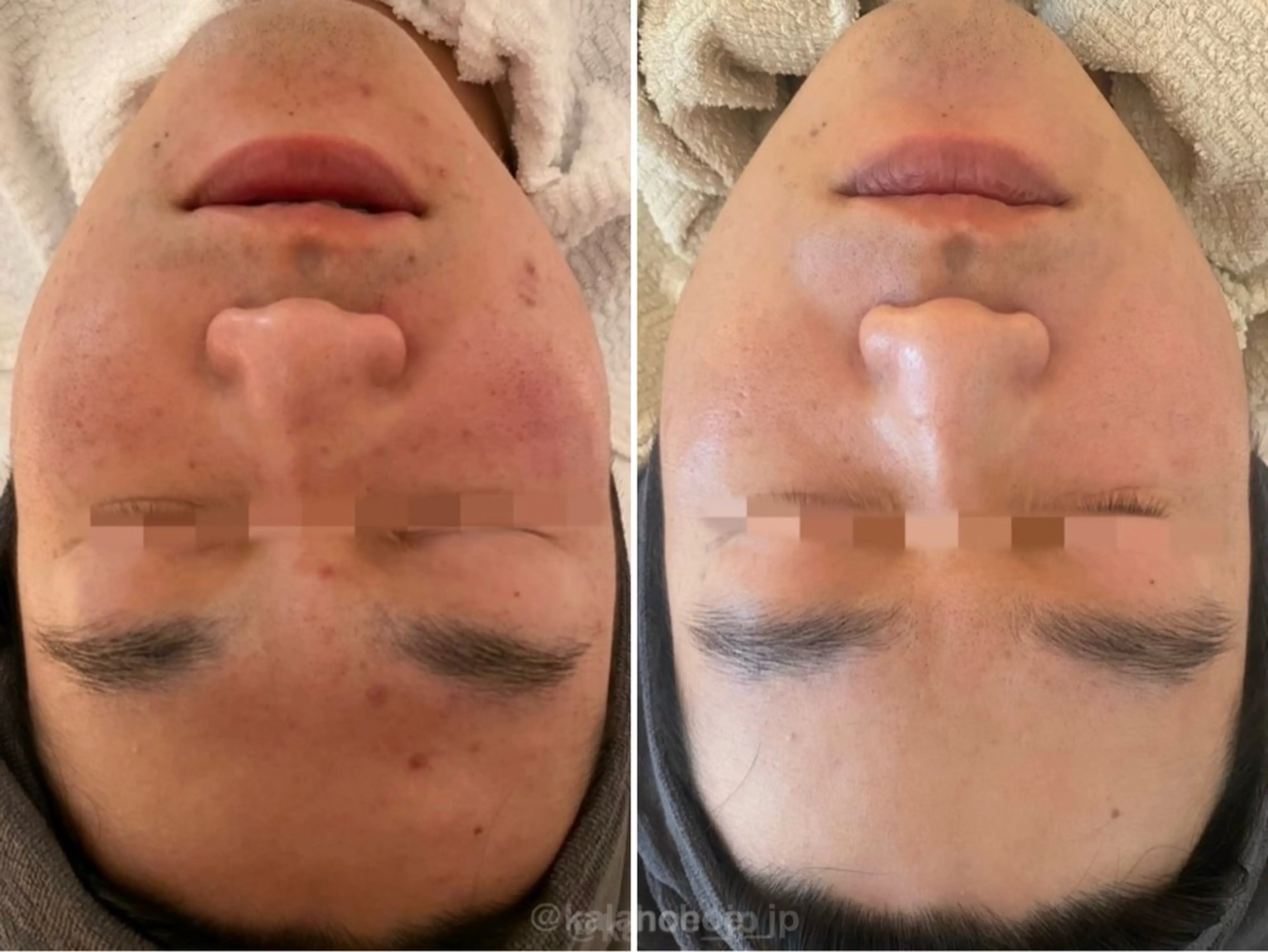 エステ 肌質改善 KALANCHOEのエステ・リラクイメージ