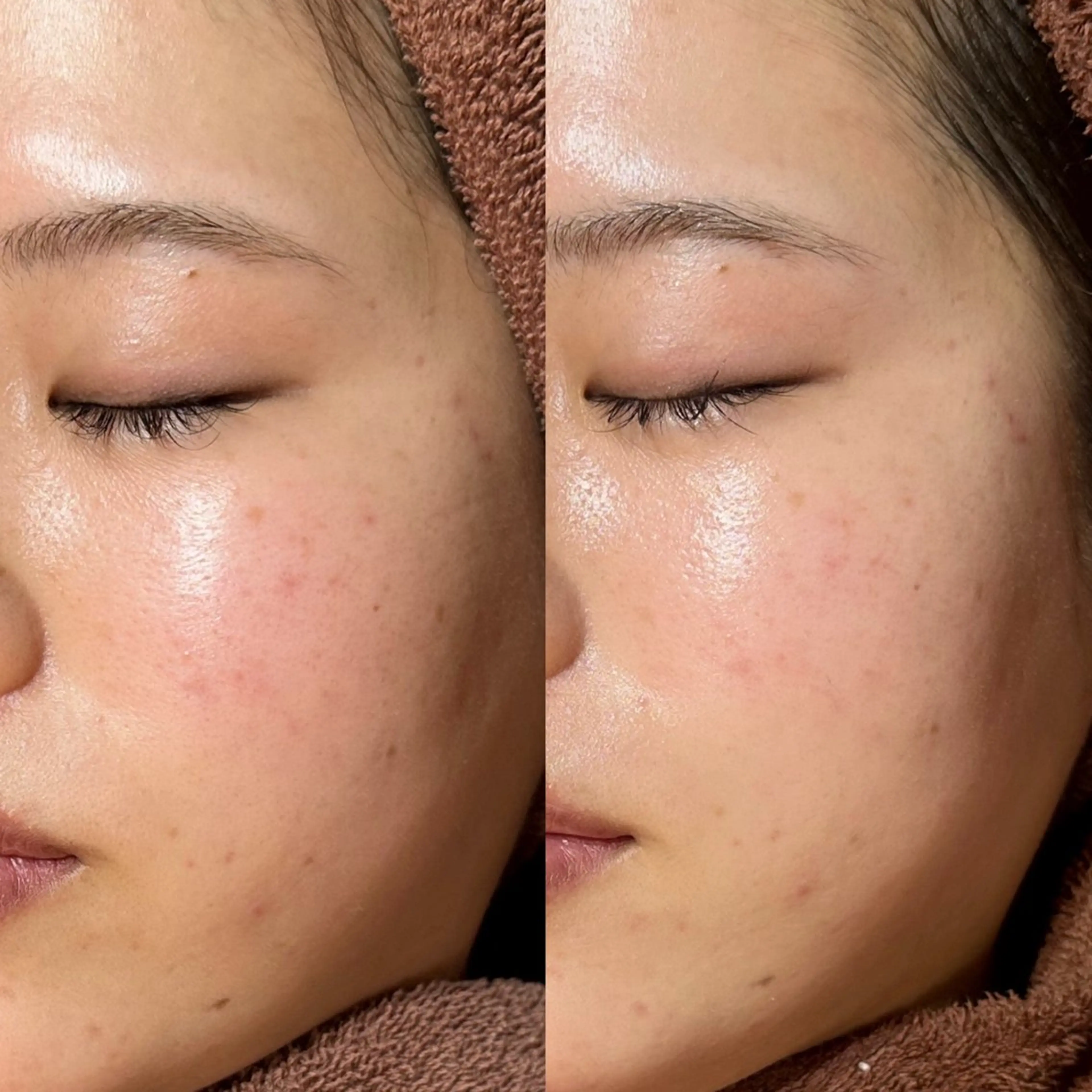 ニキビ/ニキビ跡ケアの写真