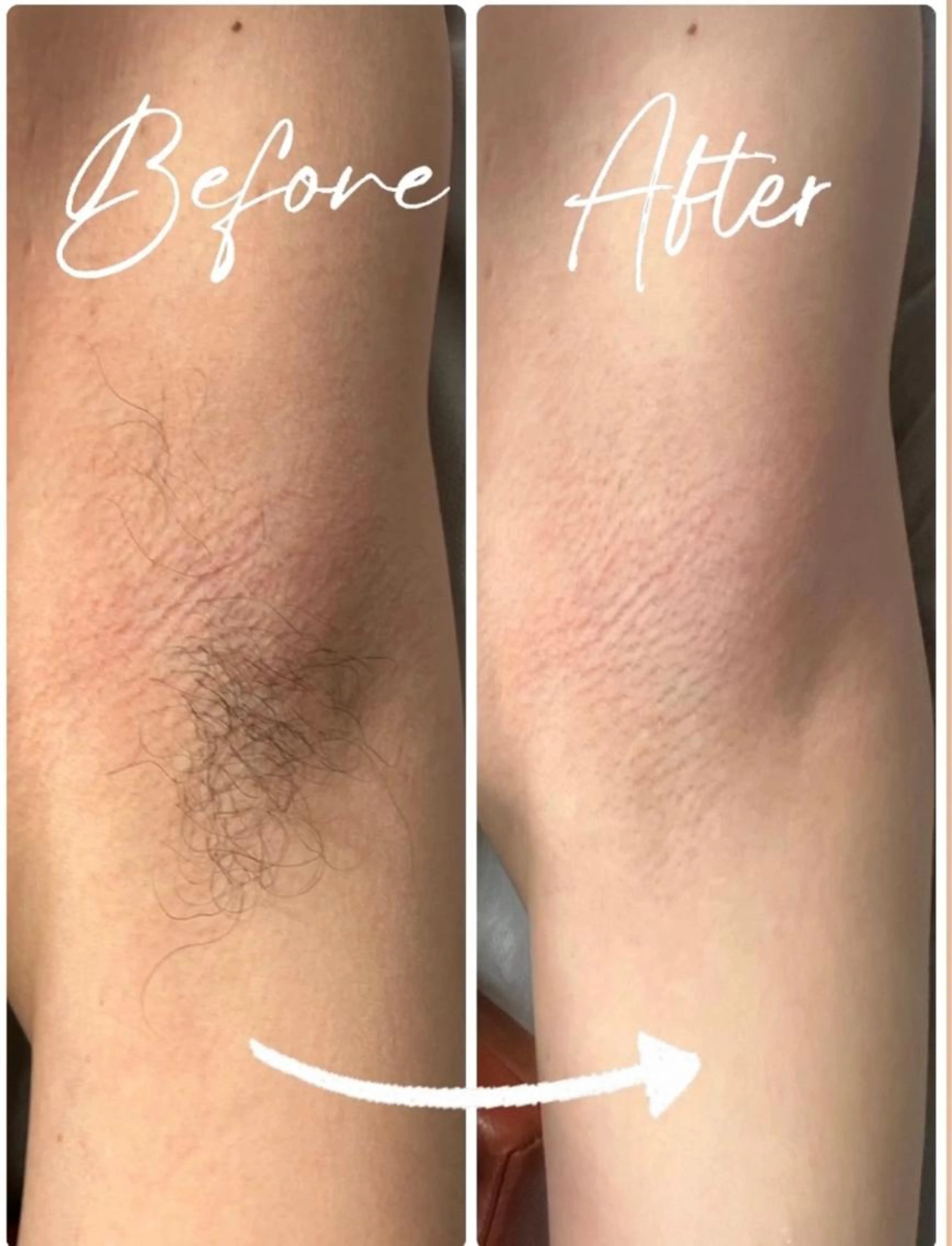 💡1日2名限🐕定通常価格より80%オフSHR全身脱毛（VIO、顔除く）の写真