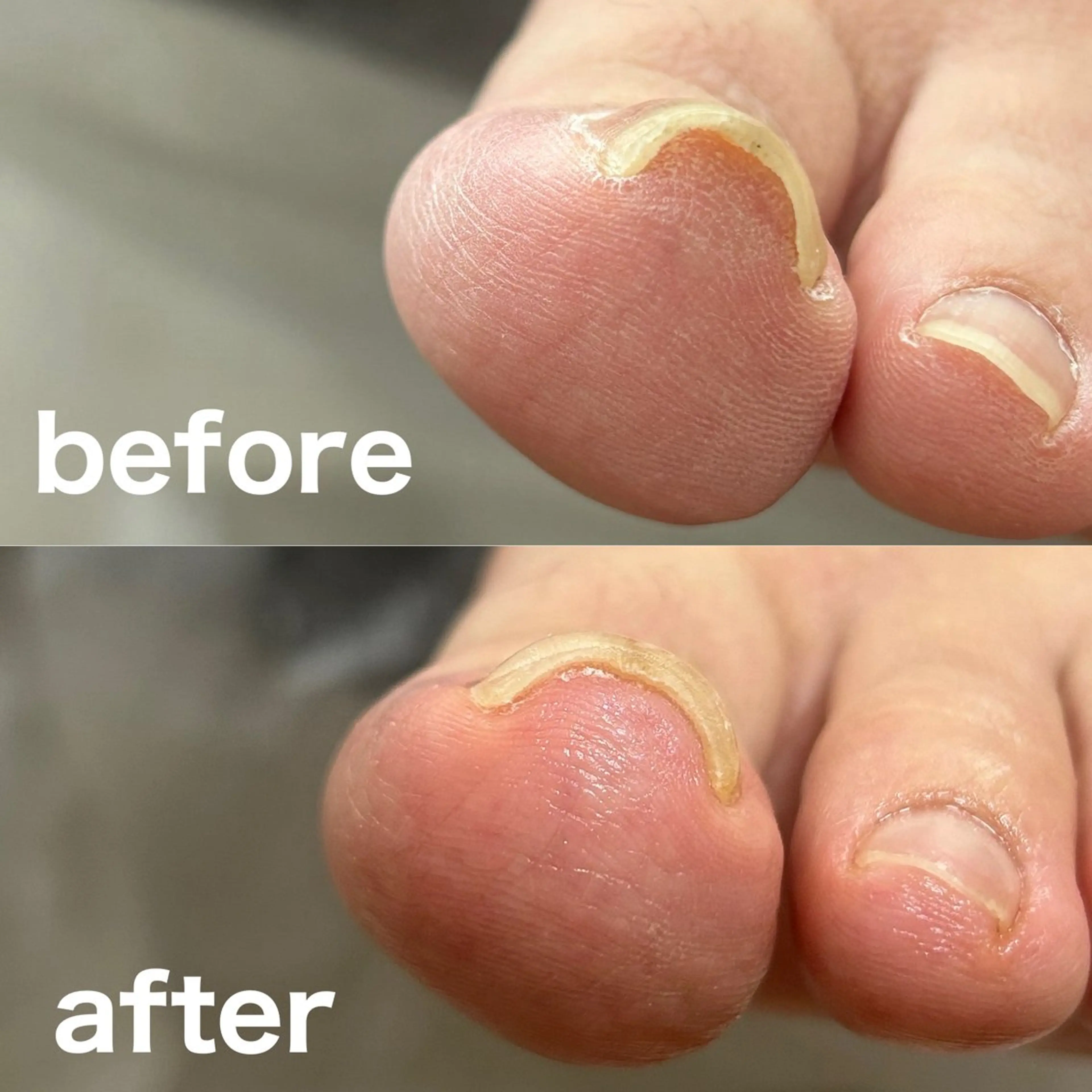 その他 巻き爪フットケアサロンKotori所属・フットケアサロン Kotoriのその他イメージ