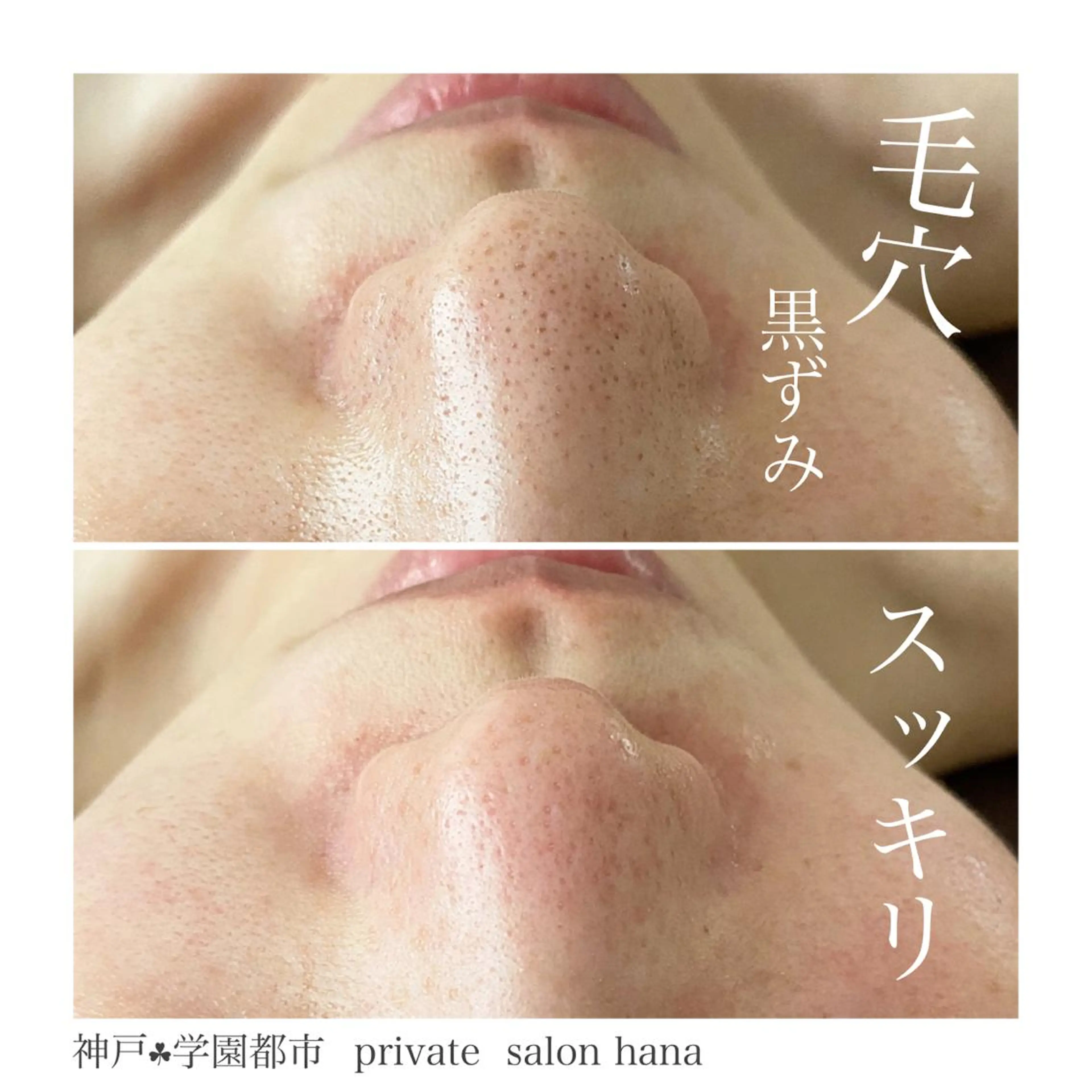 【角栓黒ずみ毛穴脱出❗️憧れのちゅるん肌に✨】3ヶ月改善コースの写真