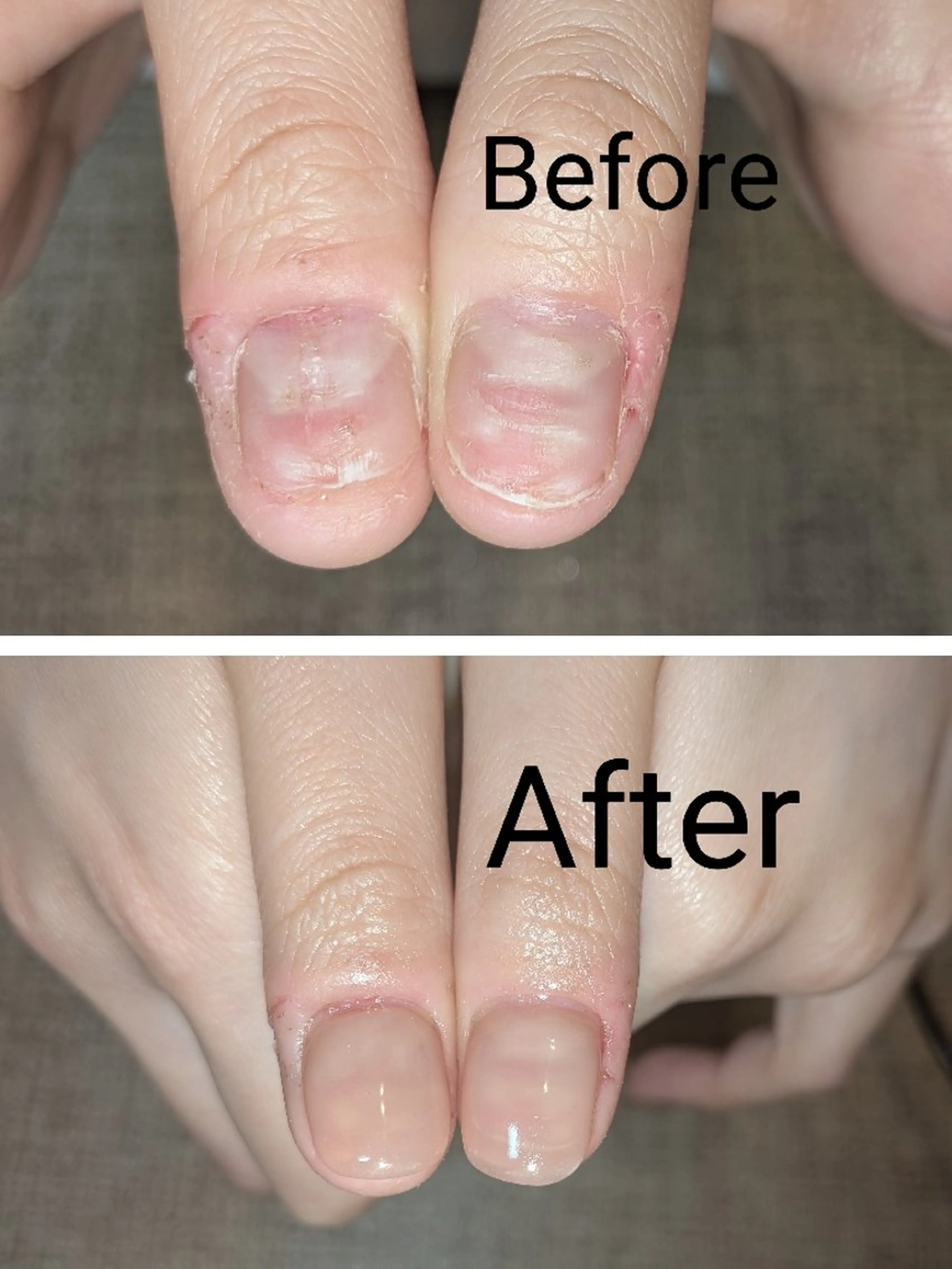 ネイル ハンドネイル ハンドケア ネイリストゆか💅 長さだし、深爪矯正のネイルデザイン