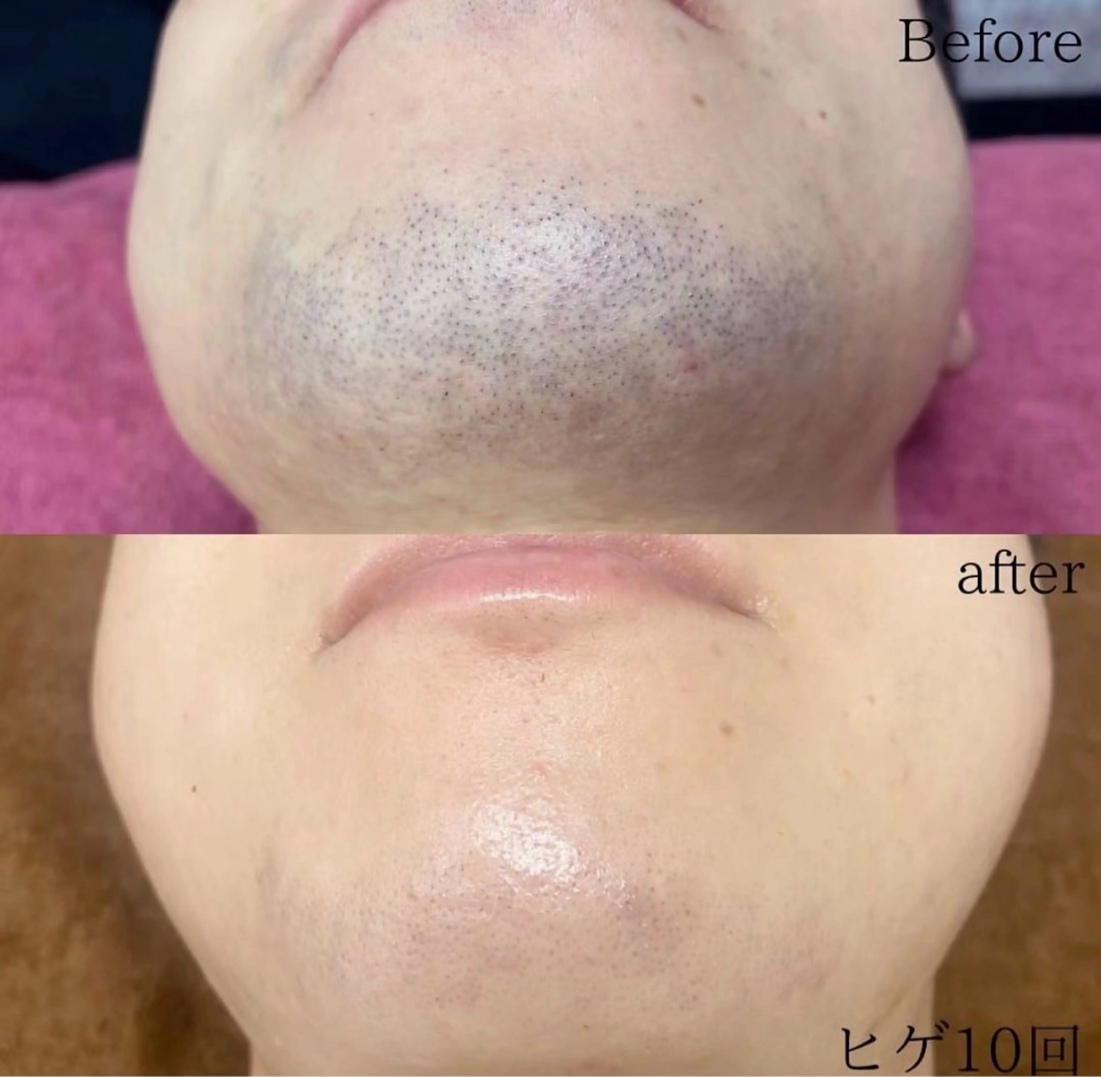 【リニューアルオープン価格】🗣️通常価格6,600円　⭐️全顔脱毛（鼻下、口下、顎、顎下、首、もみあげ、両頬、おでこ）の写真