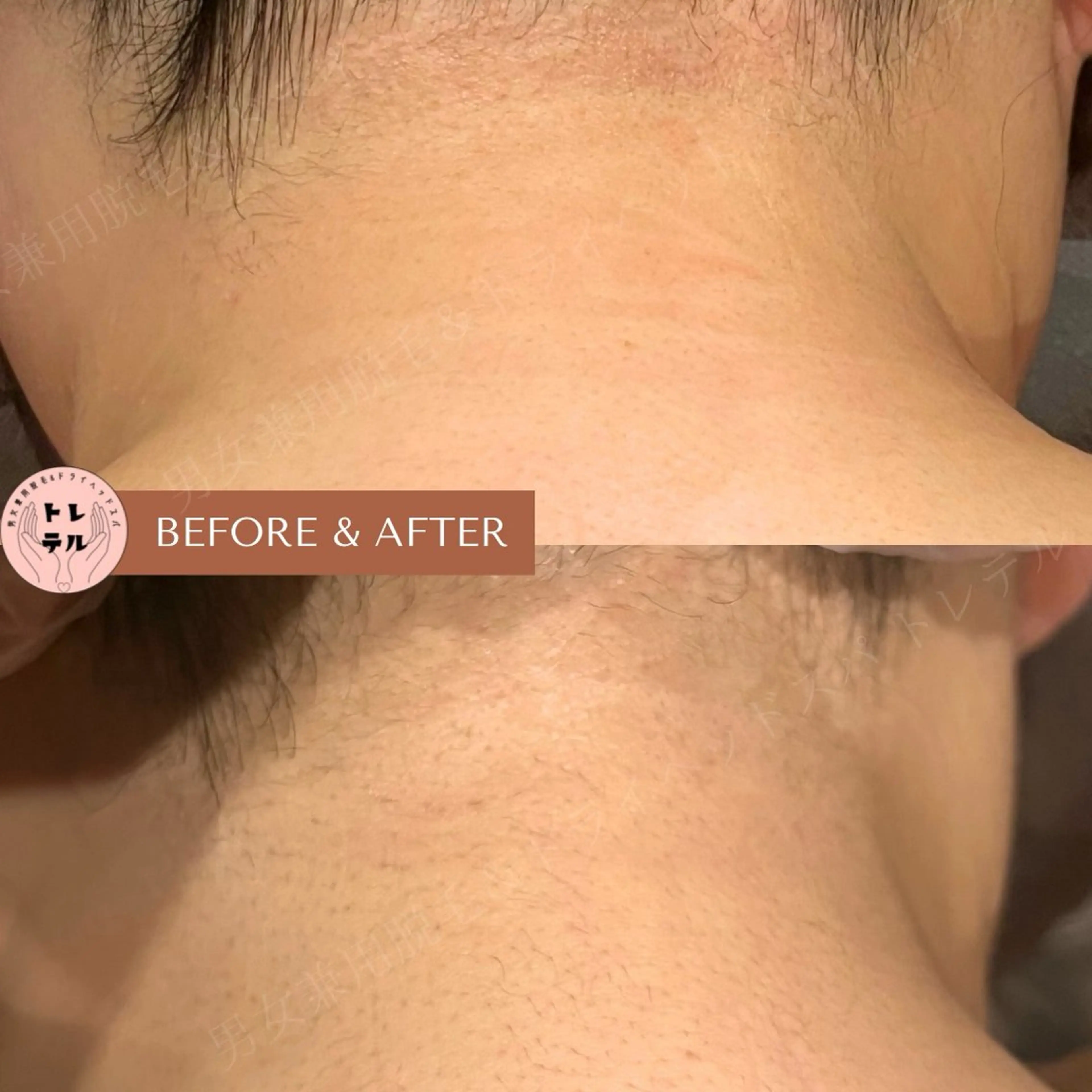 脱毛 男女兼用脱毛&ドライ ヘッドスパ トレテルのエステ・リラクイメージ