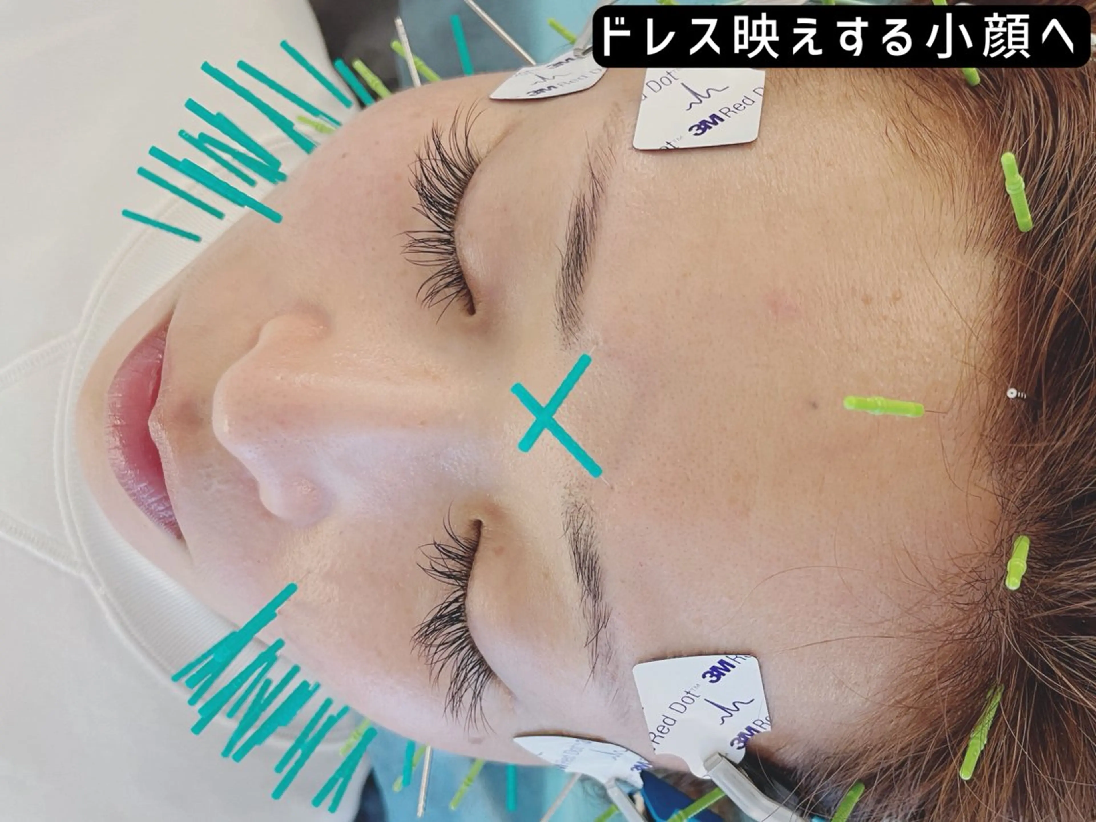 【ブライダル・撮影前◎顔と体のトータルケア】美容整体×EMS美容鍼 90分の写真