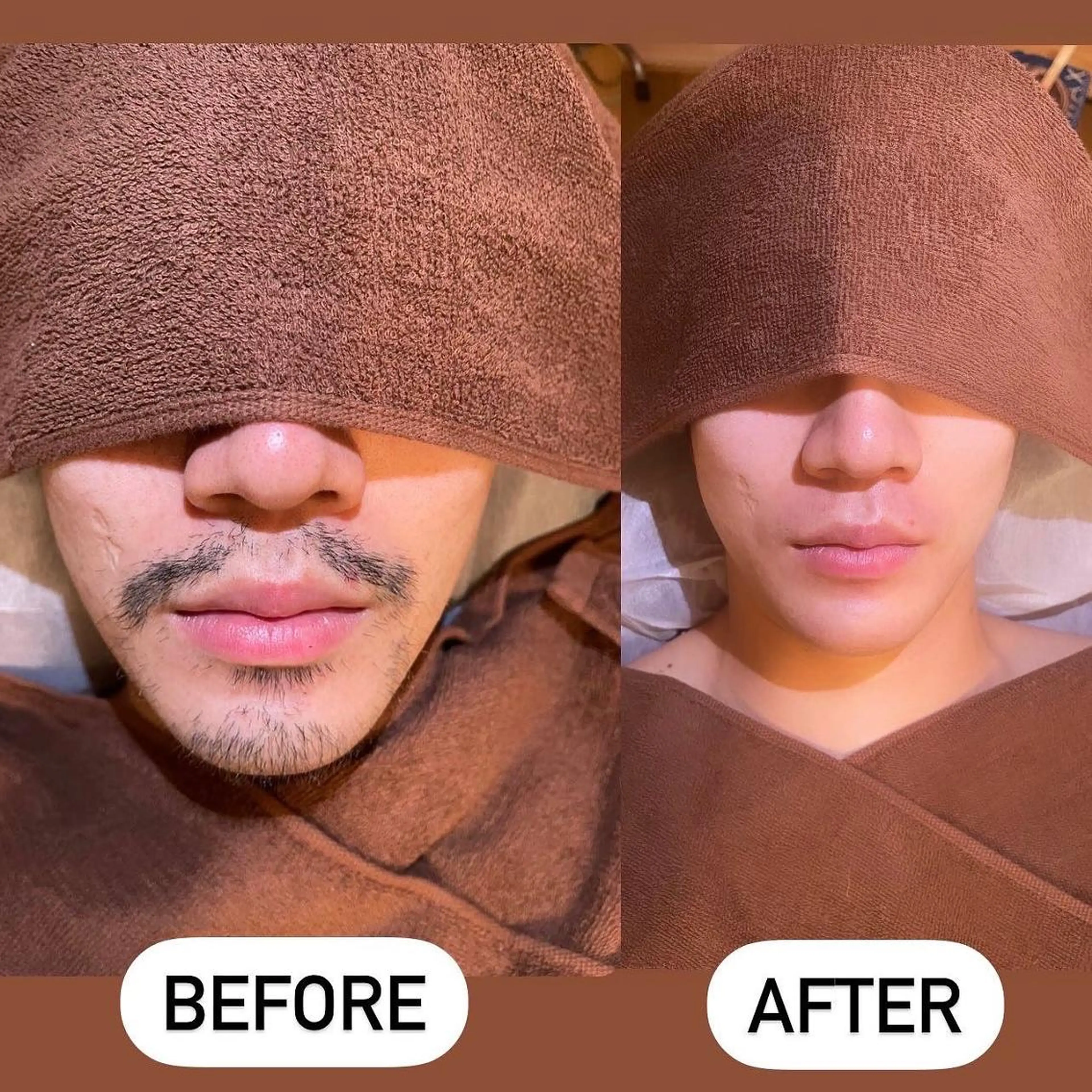 ✨ メンズ ✨ヒゲ　髭　ひげ　ブラジリアンワックス脱毛￥6500✨の写真