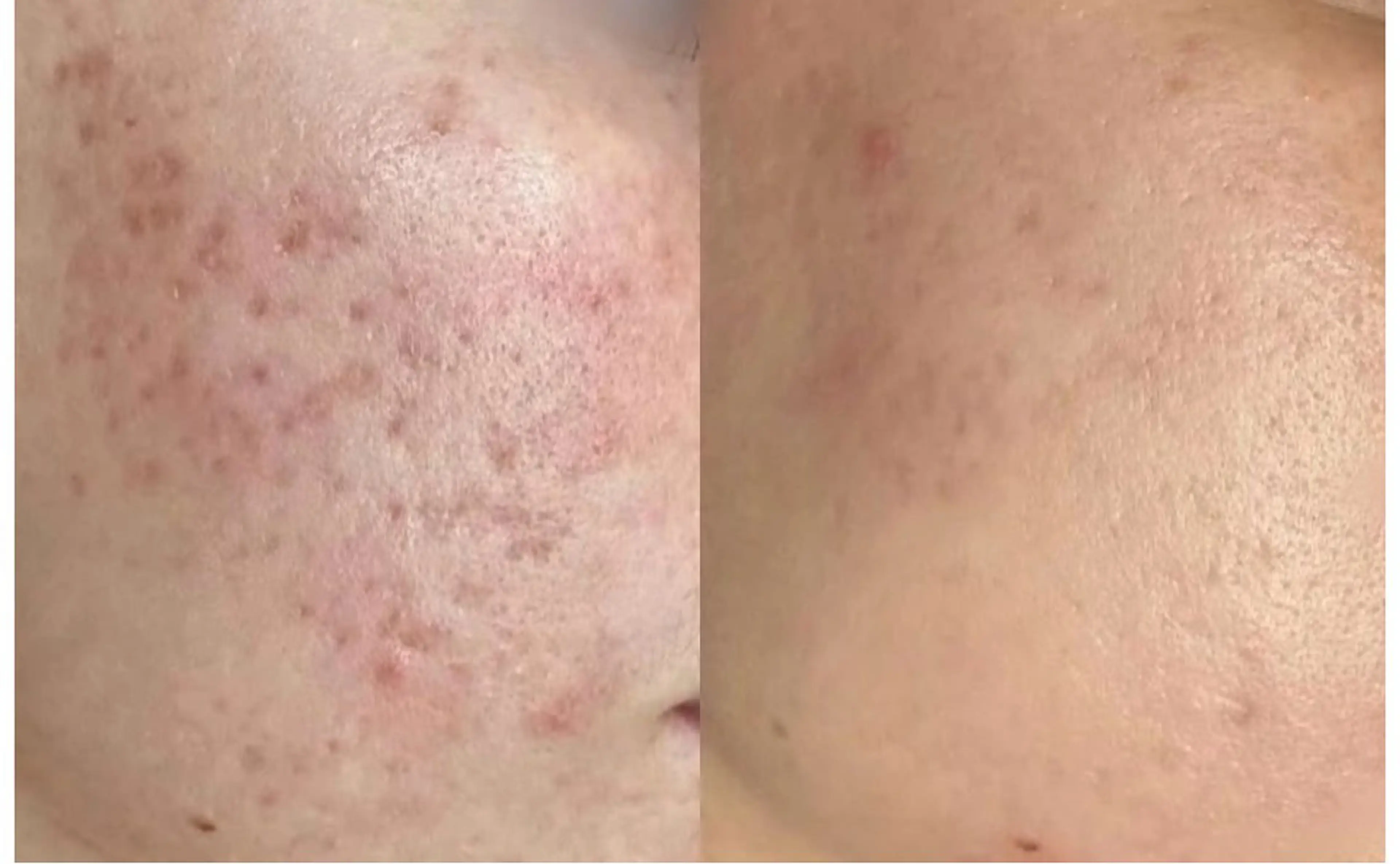 ニキビケアコース　お試しの写真