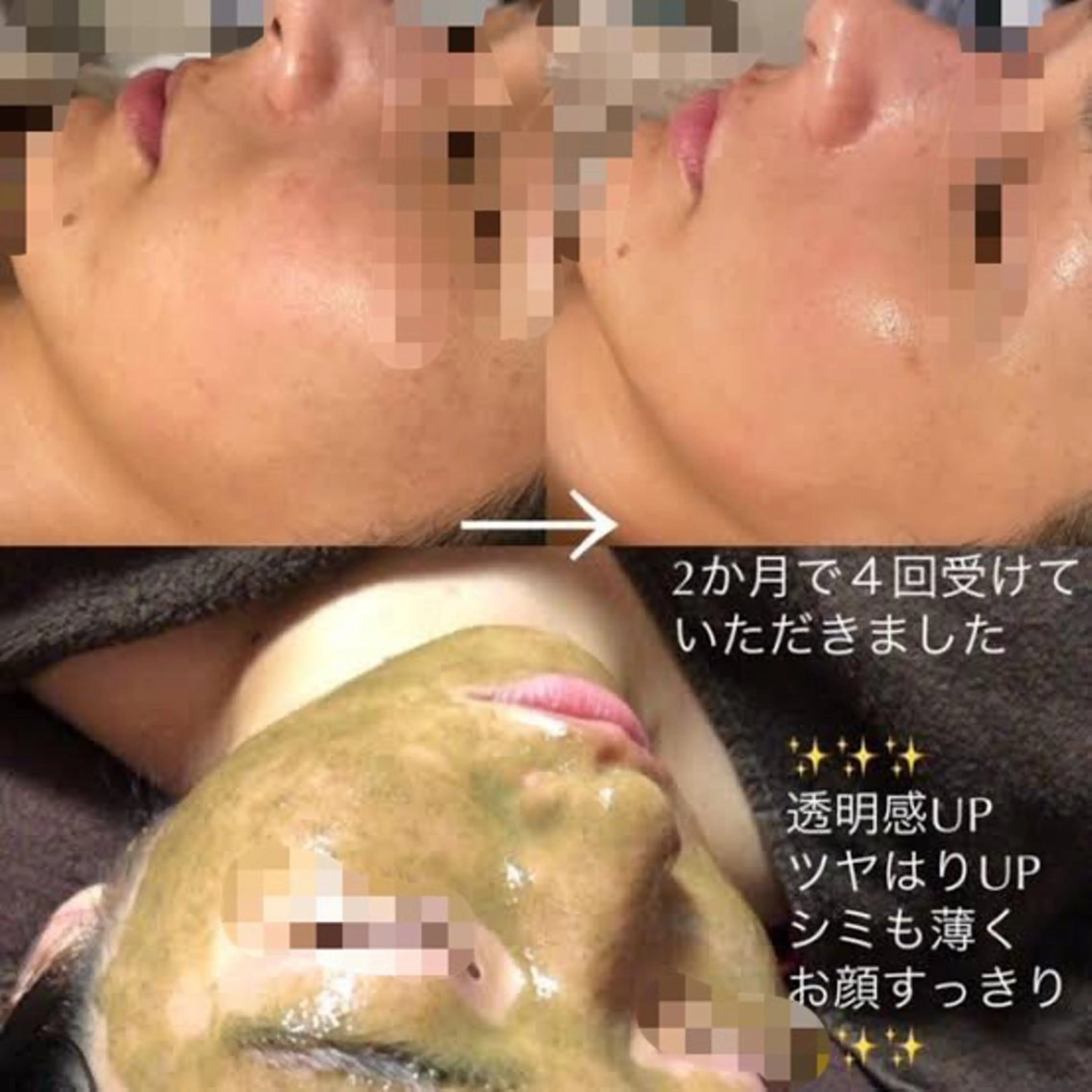 【ニキビケア/毛穴徹底改善】剥離なしハーブピーリングの写真