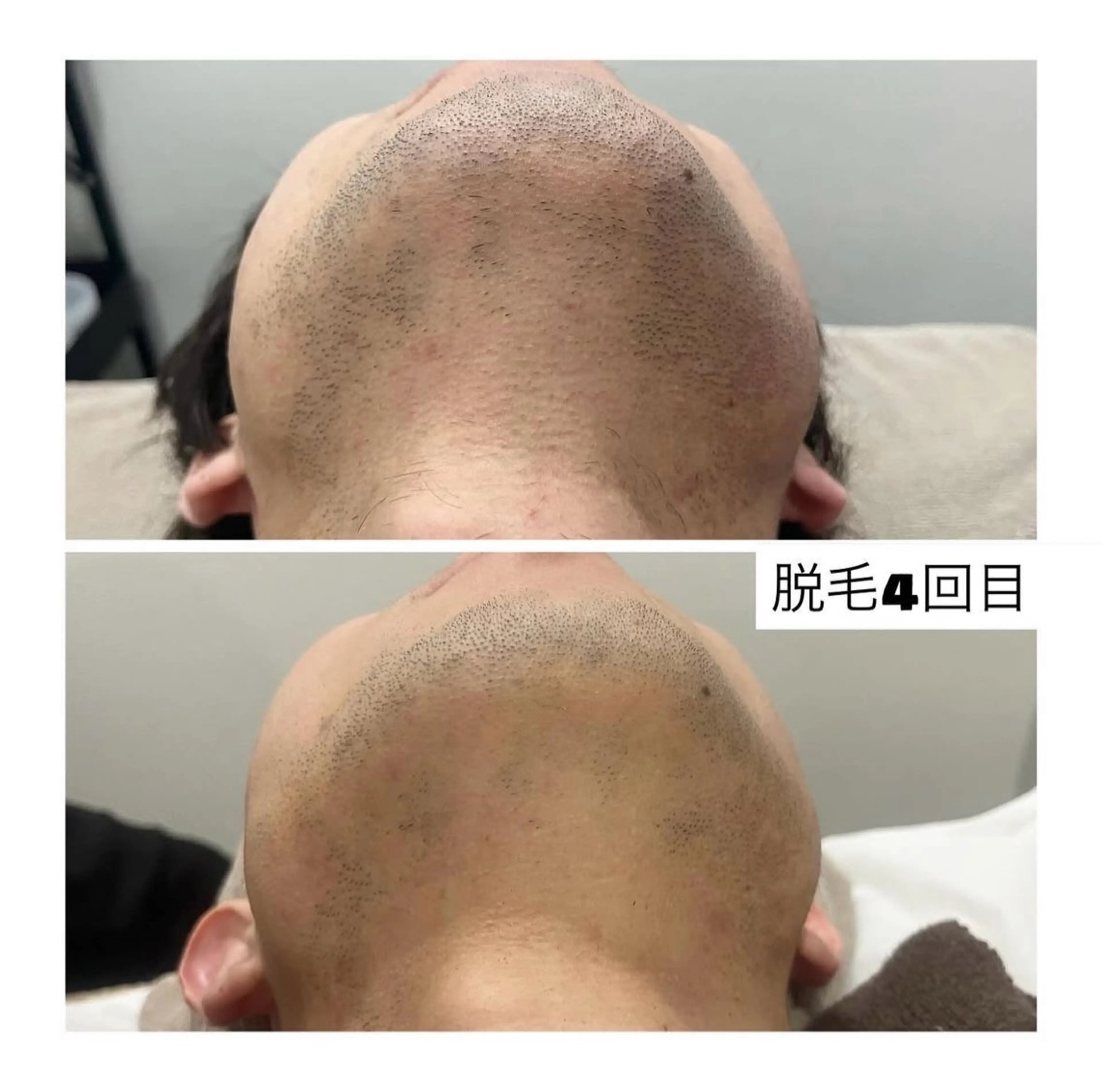 【メンズ】ヒゲ脱毛1パーツ体験の写真