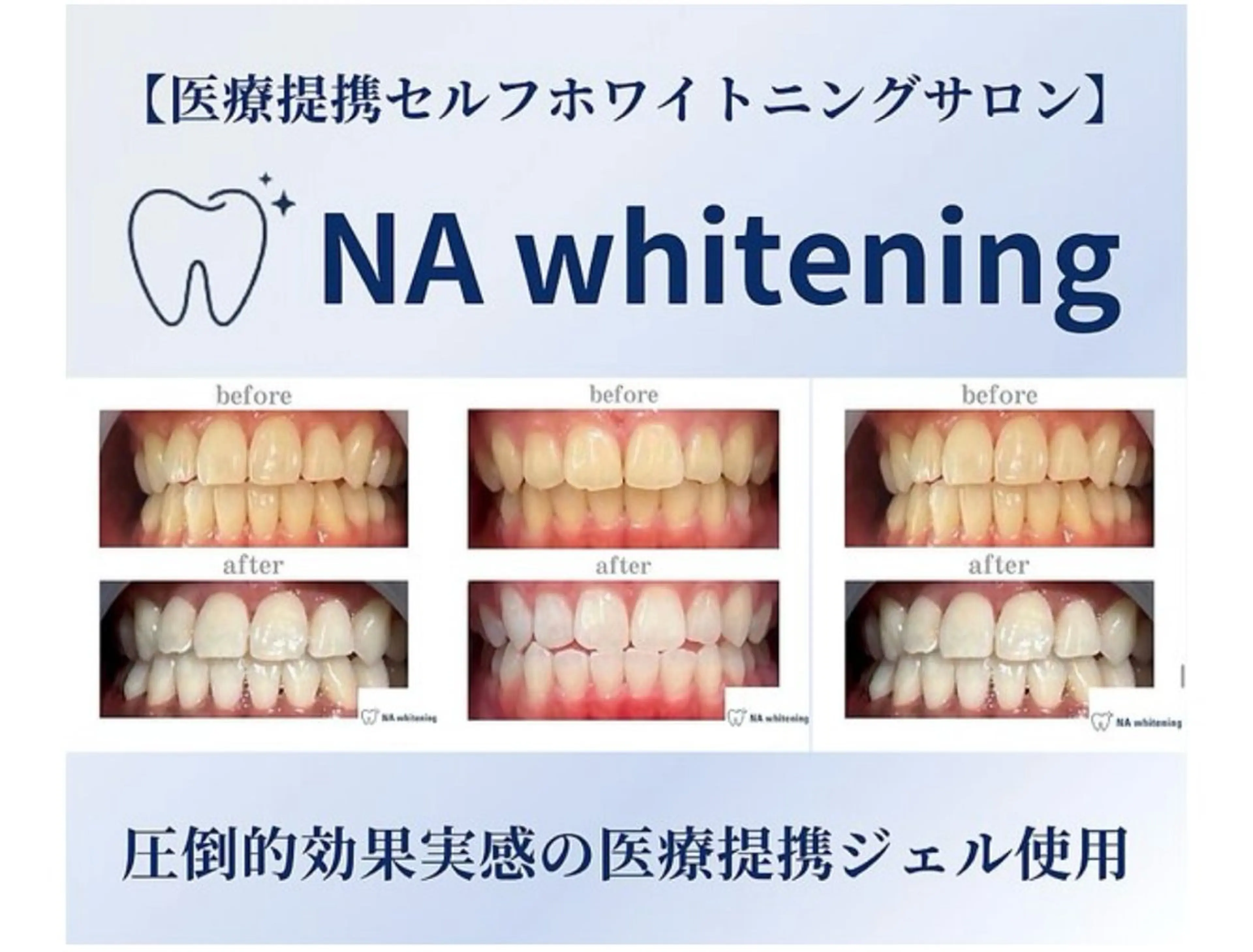 美しい歯へ✨医療提携薬品を使用し、効果が早く痛みのないホワイトニングです。おの写真