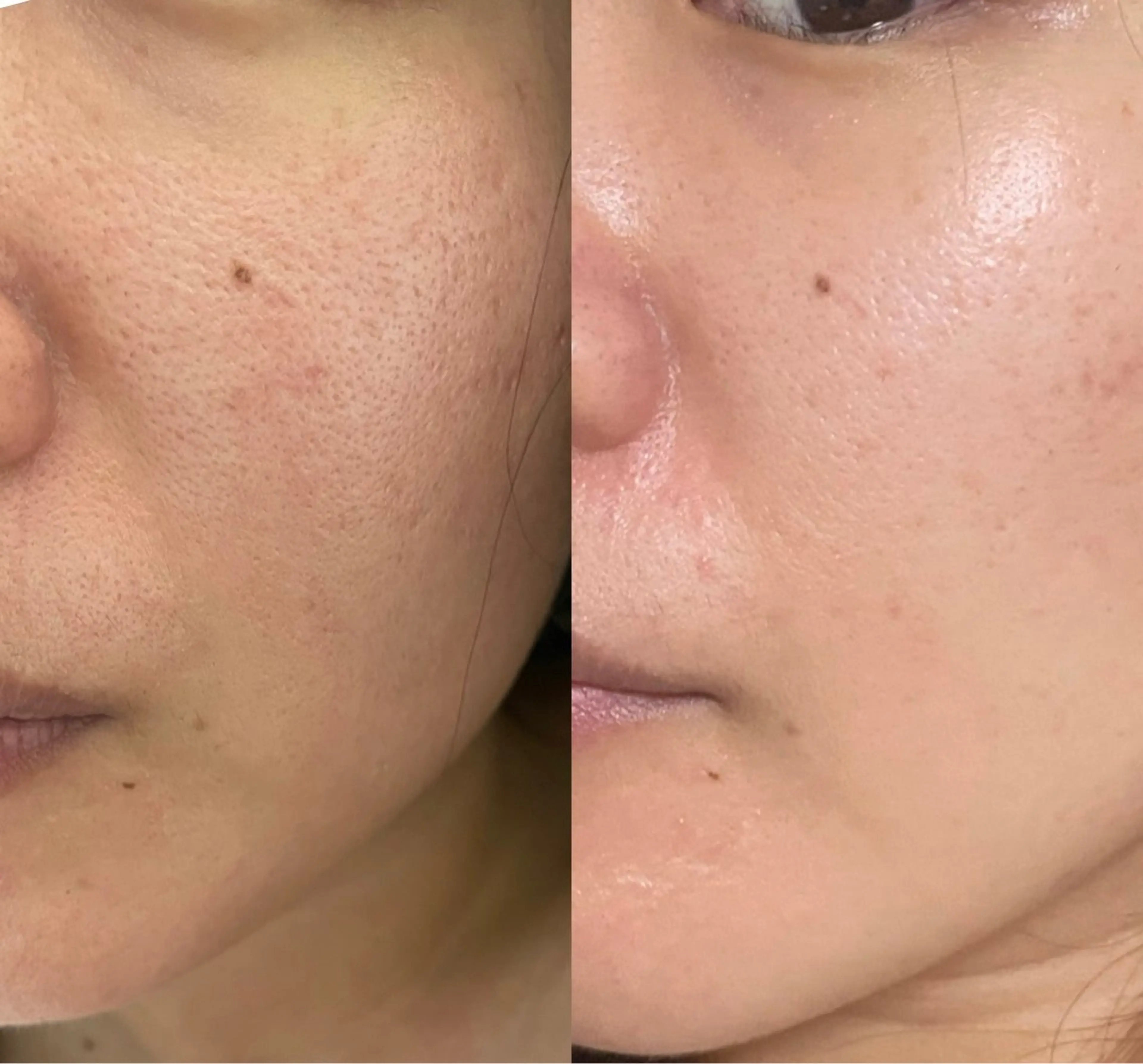 毛穴悩みの方に1番人気☆《毛穴徹底ケア》スチームマッサージ＆超音波エステ(毛穴専用パック付き)の写真