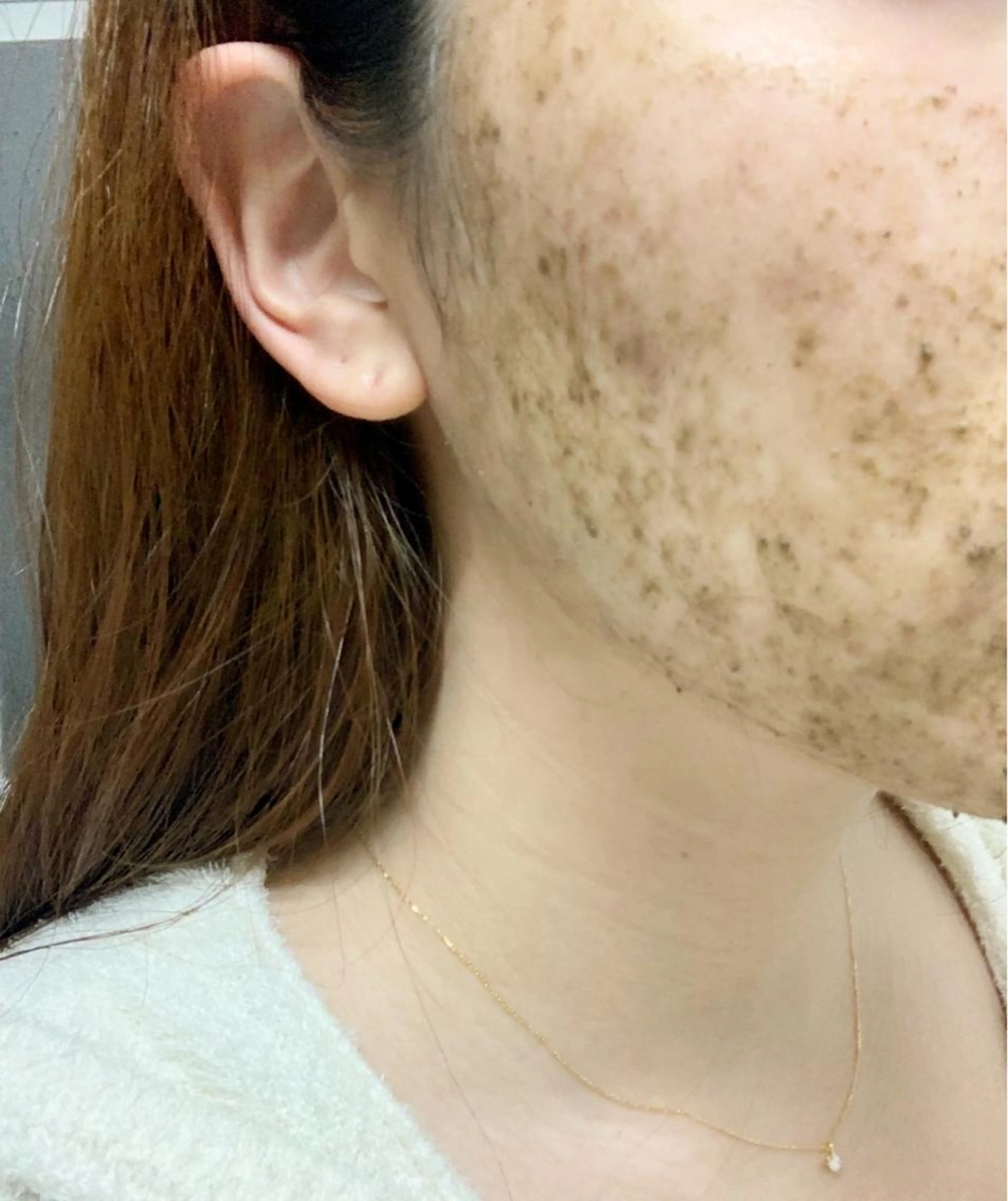 大人気！肌質改善✨ニキビケア‎🤍お肌のざらつき‎🤍つるつるお肌へ‎🤍天然ハーブピーリング￥7800🌿‬の写真